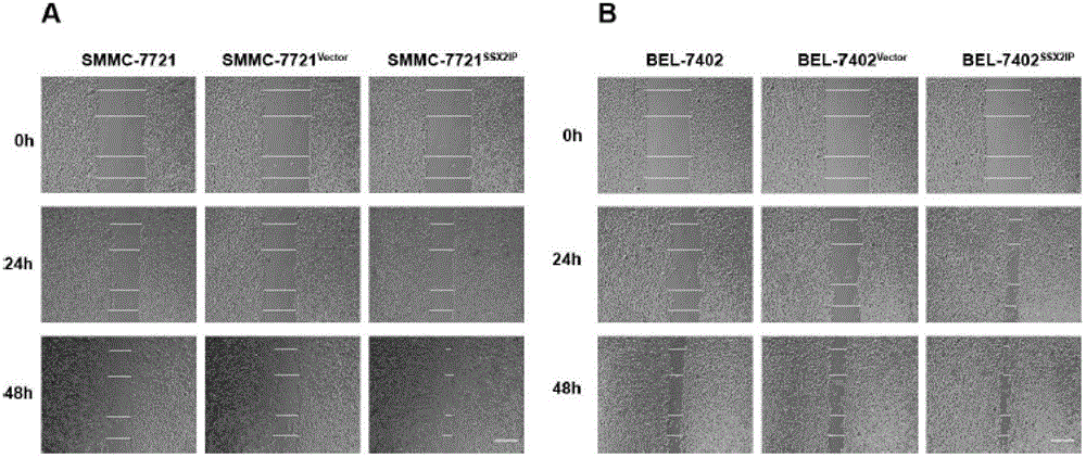 Application of SSX2IP in predicating or diagnosing tumor metastasis