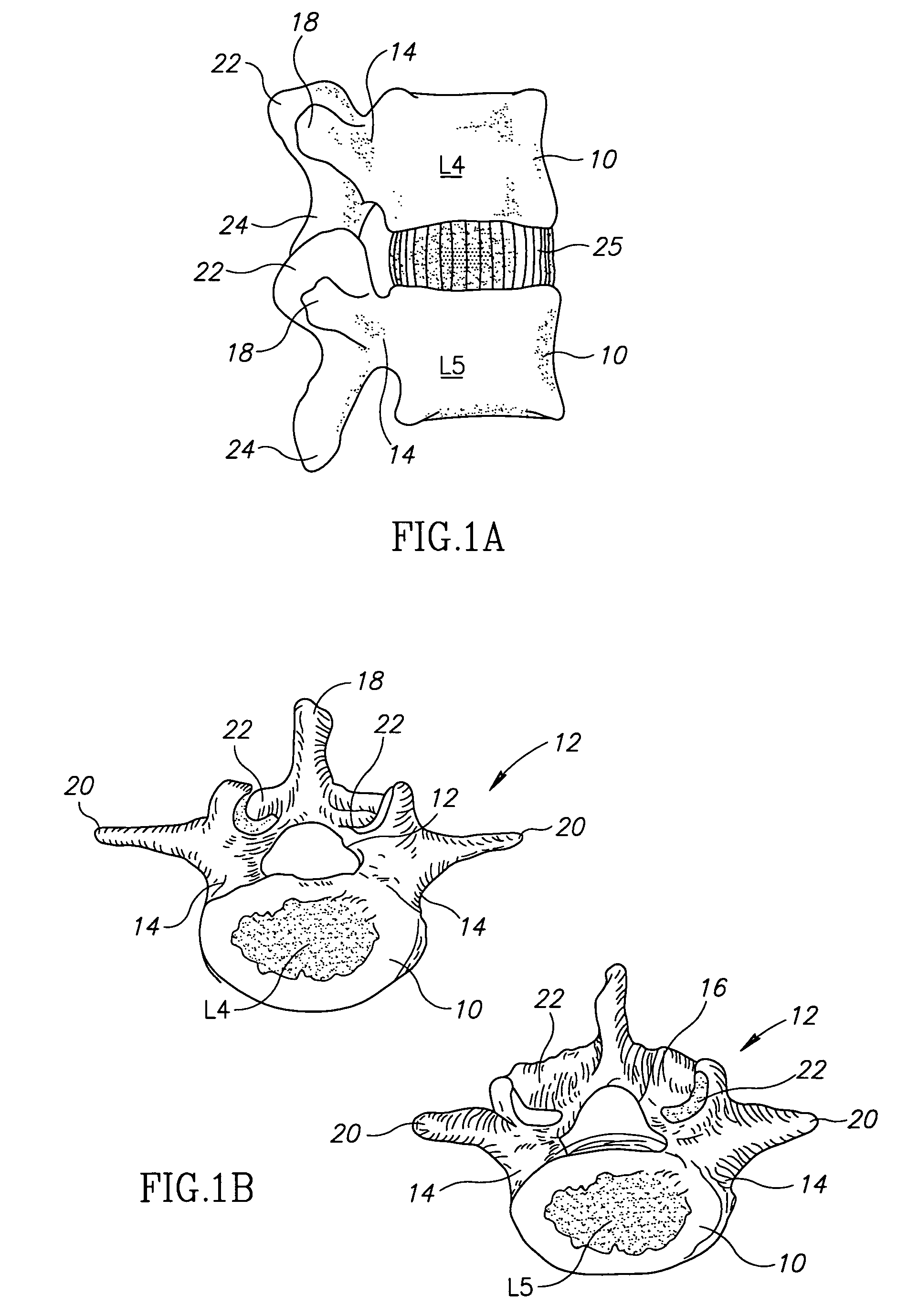 Facet prosthesis