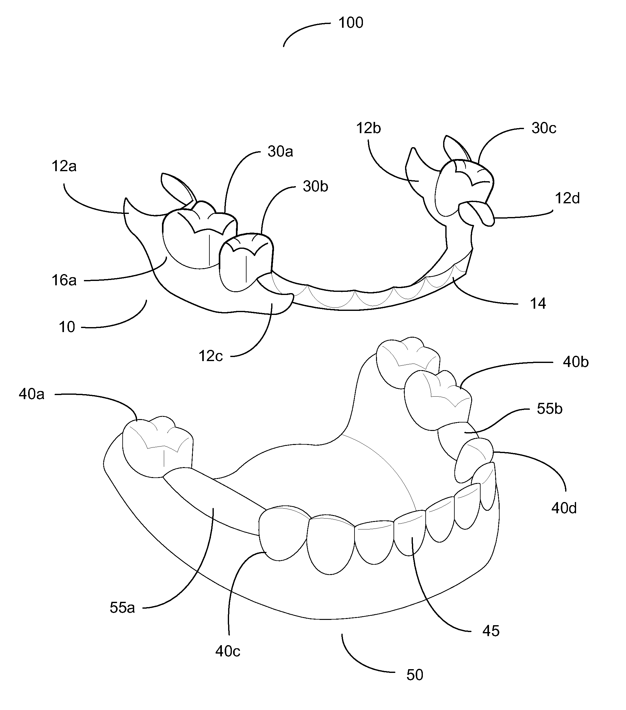 Removable Partial Dental Prosthesis