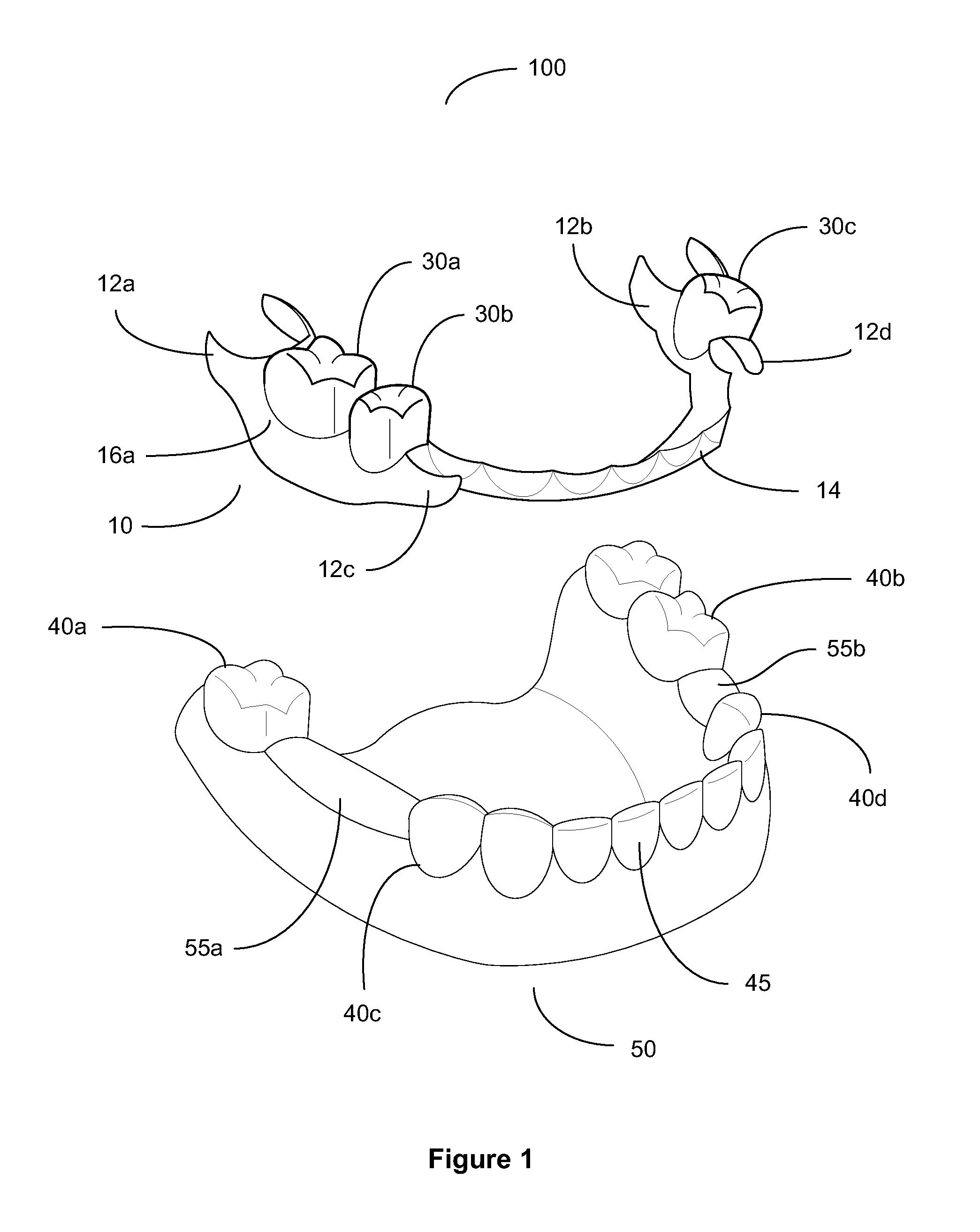 Removable Partial Dental Prosthesis