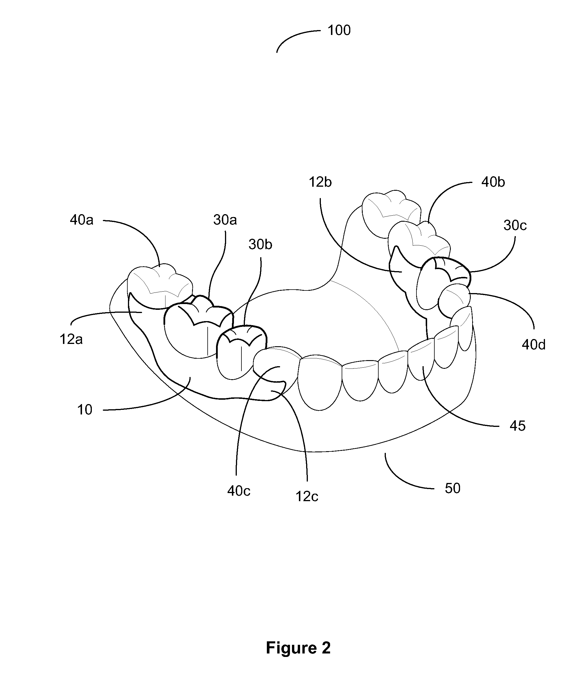 Removable Partial Dental Prosthesis