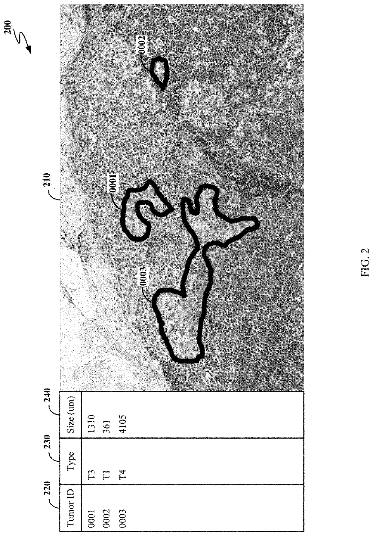 System for automatic tumor detection and classification