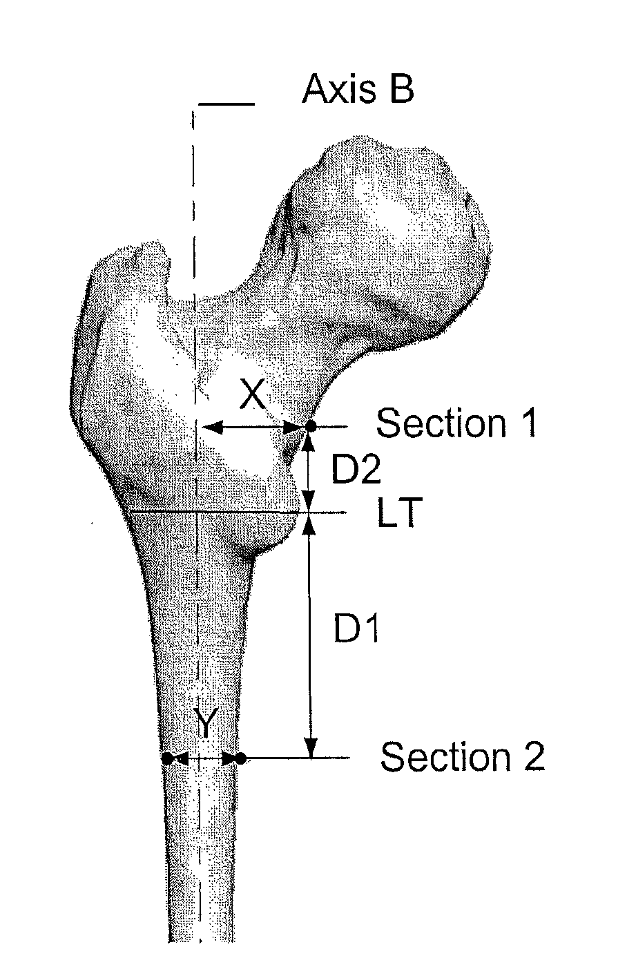 Method for designing a bone morphology based hip system