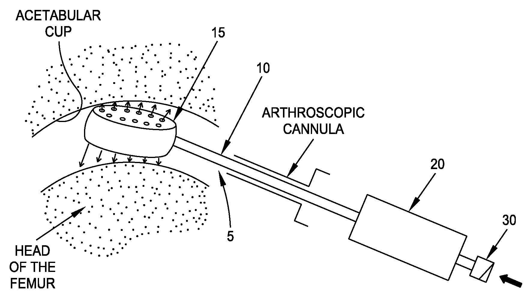 Method and apparatus for distracting a joint, including the provision and use of a novel fluid joint spacer