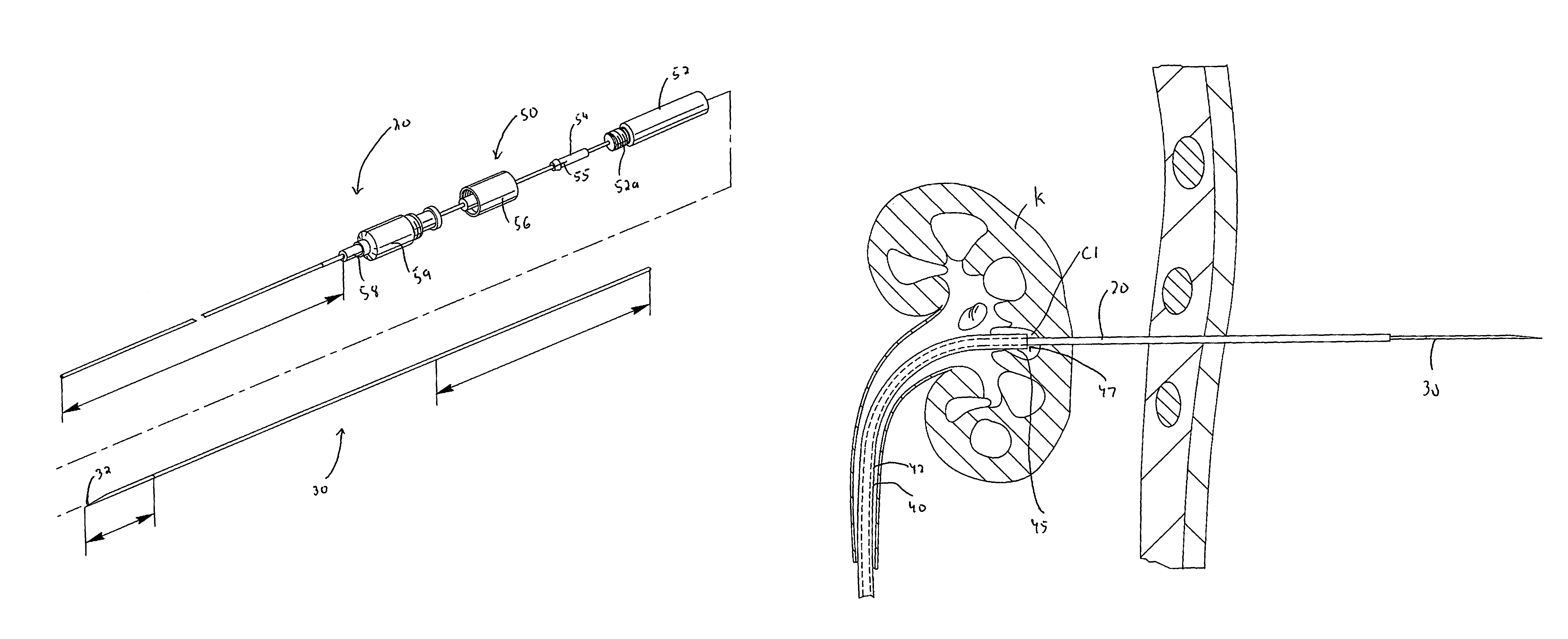 Percutaneous renal access system