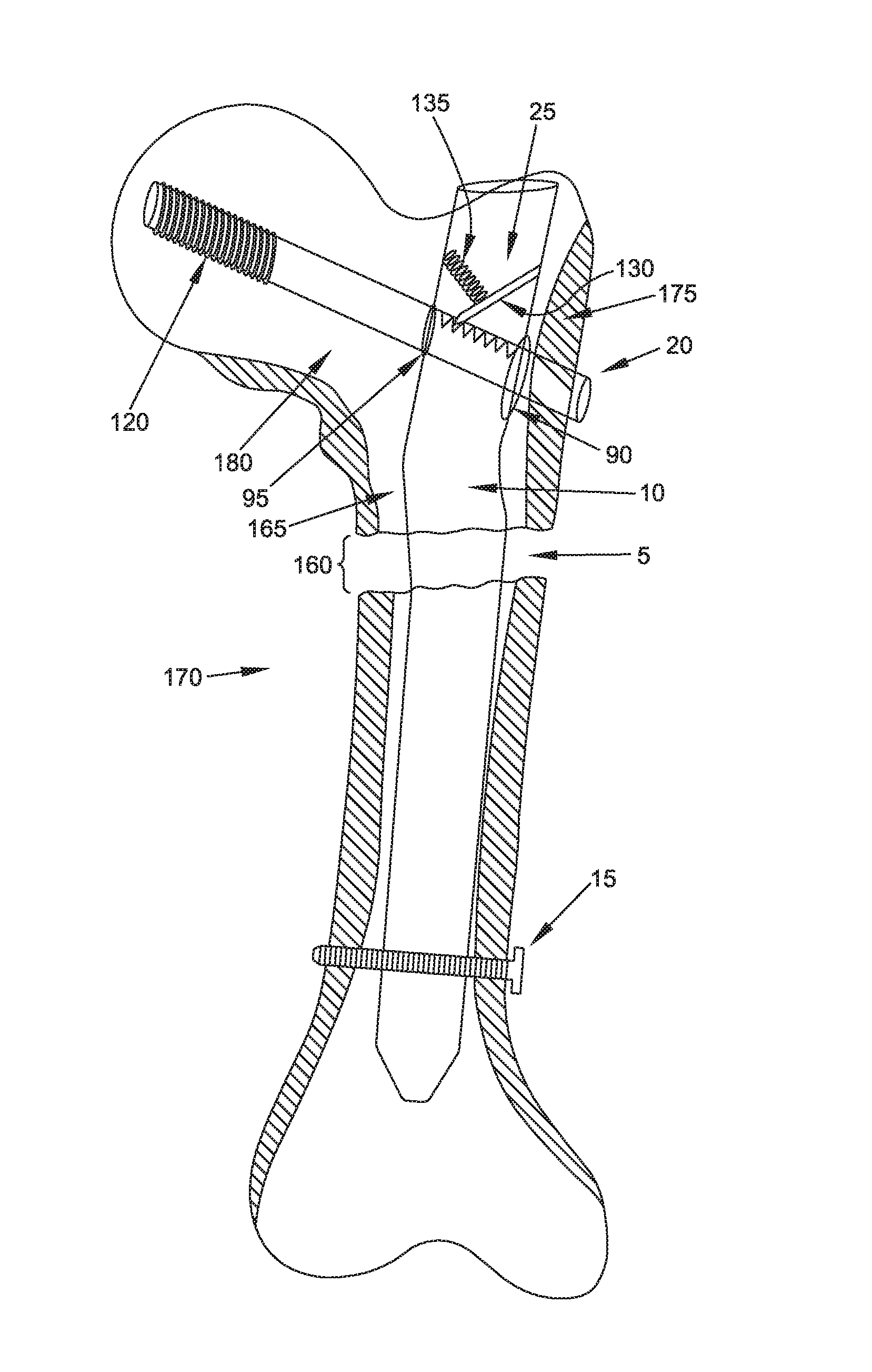 Interlocking intramedullary rod assembly for proximal femoral fractures, including unstable hip fractures