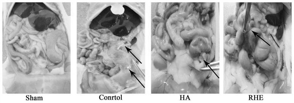 Medicine for treating postoperative abdominal adhesion, and new use of medicine