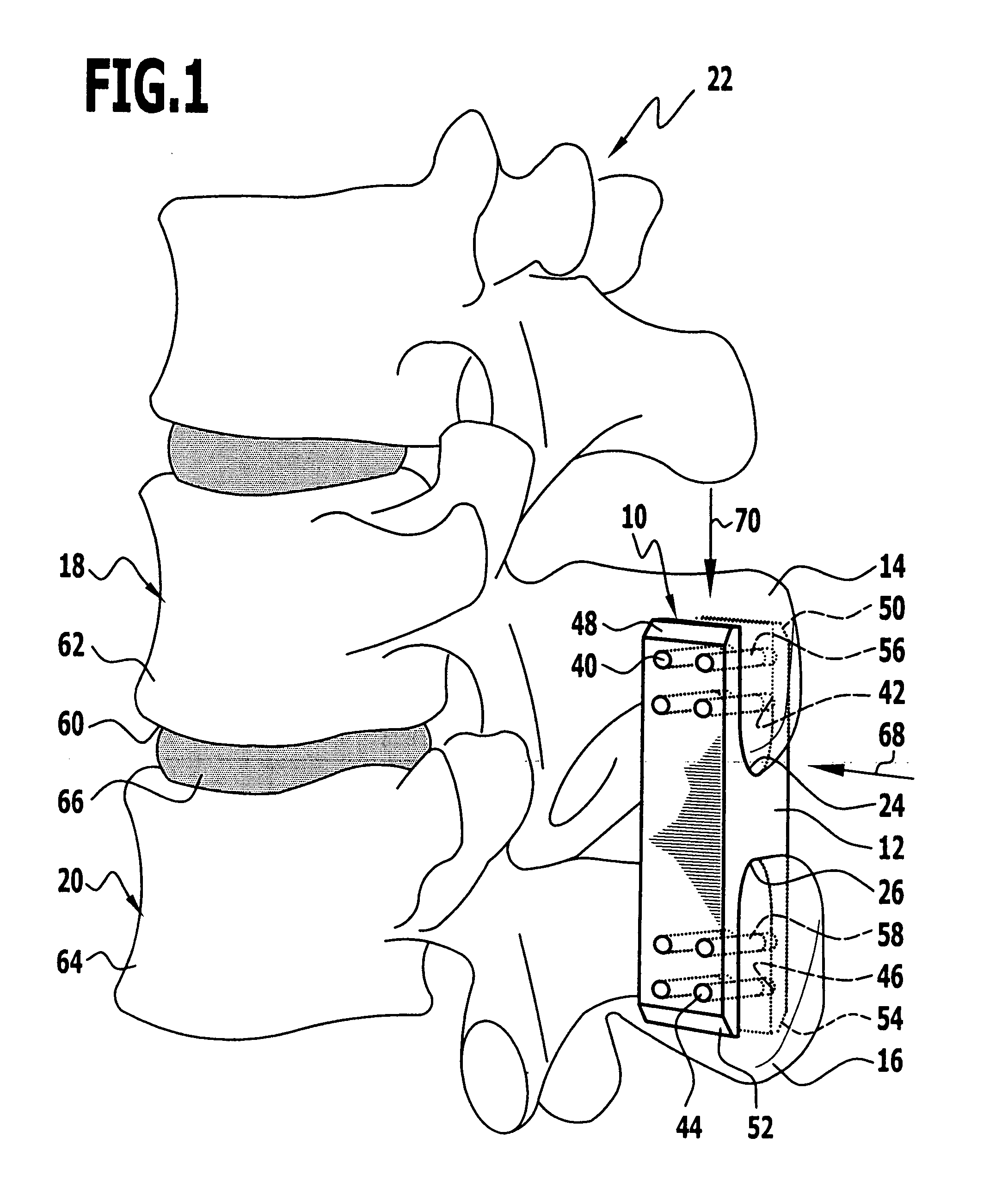 Implant for alleviating pressure on intervertebral disks and method for restoring the height of and alleviating pressure on an intervertebral space