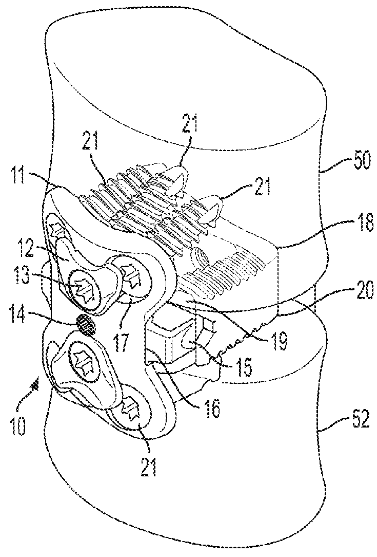 Cervical implant with exterior face plate