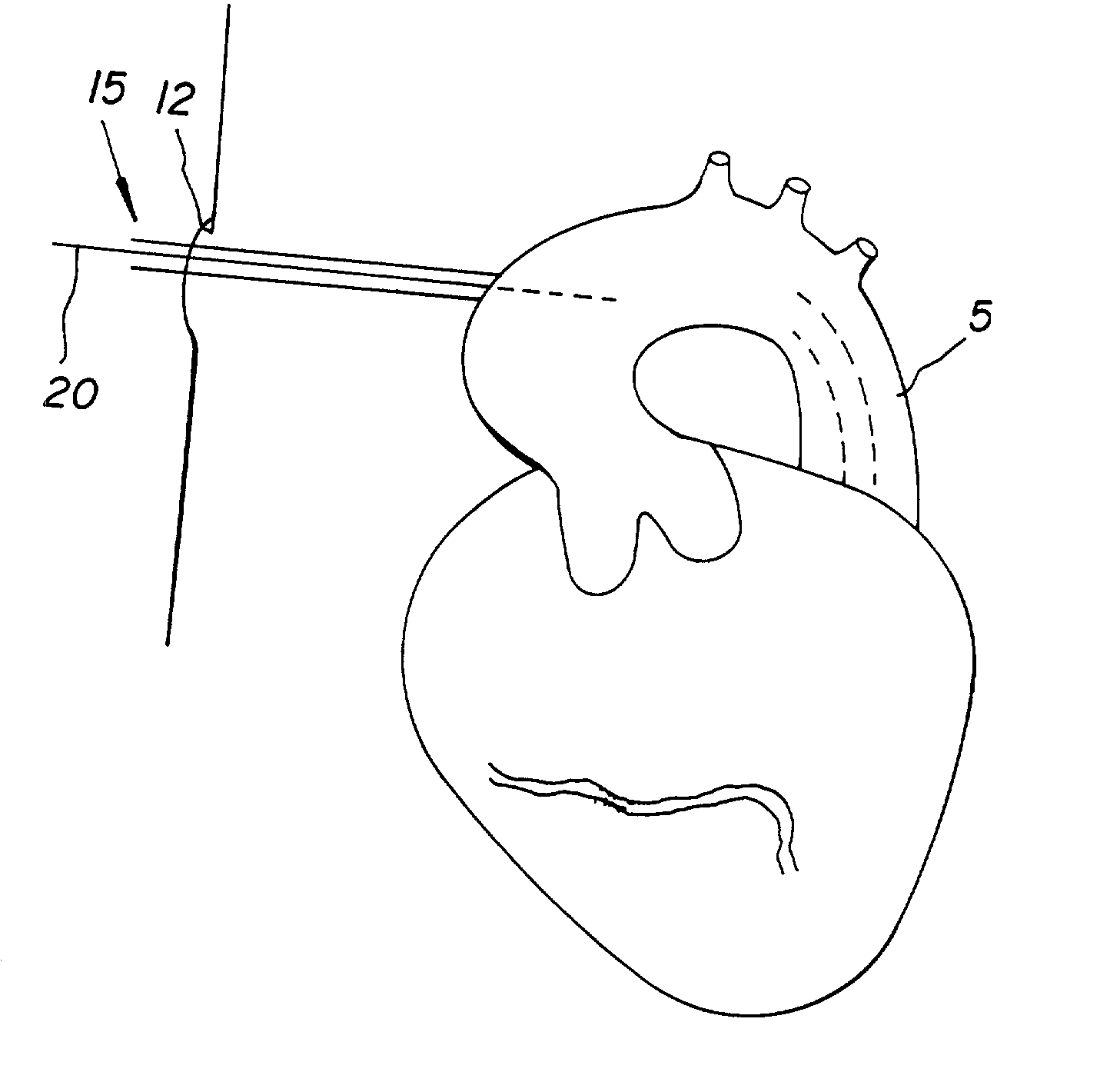 Method and apparatus for performing an anastamosis