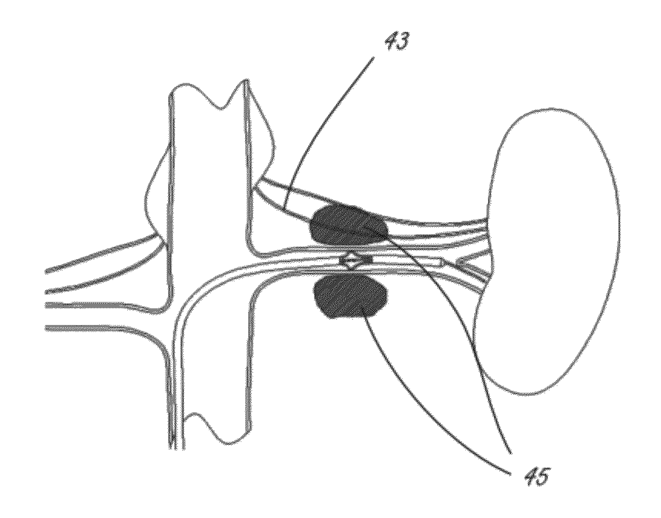 Intravascular Tissue Disruption