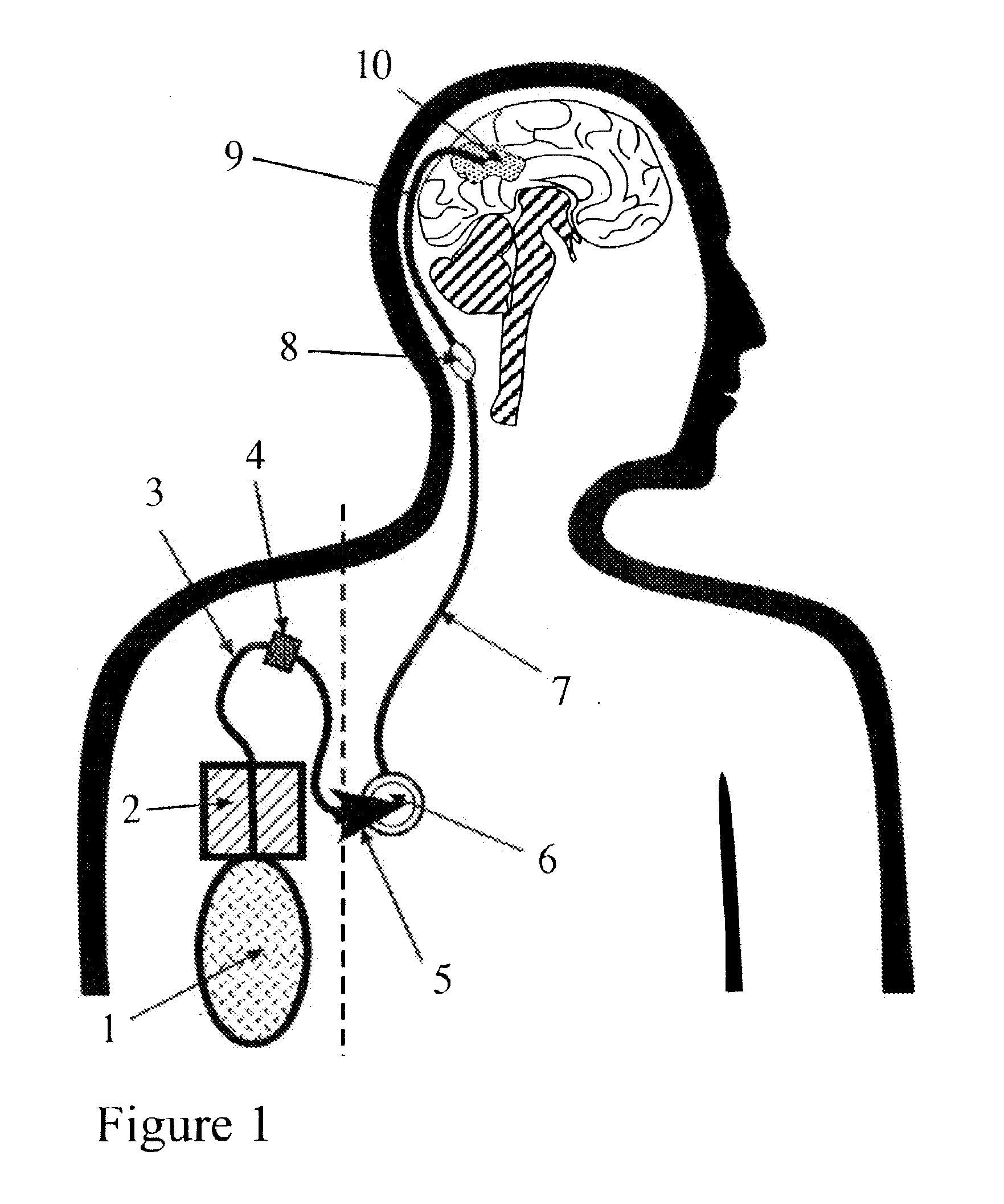 Portable equipment for administration of fluids into tissues and tumors by convection enhanced delivery technique