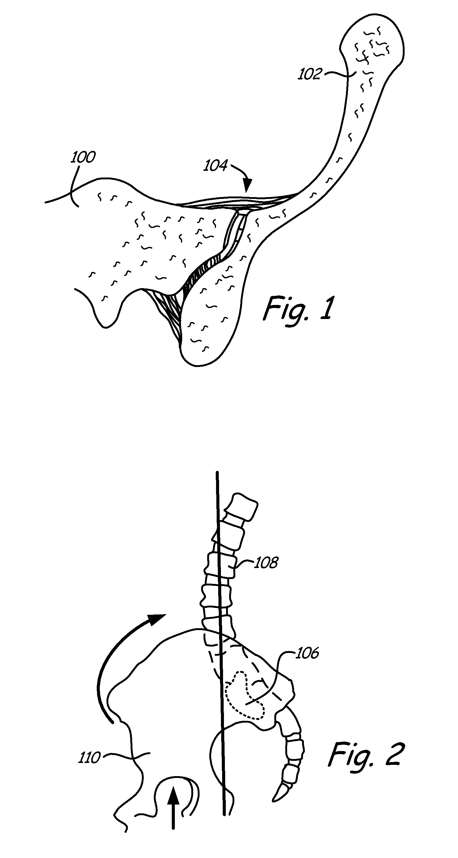 Sacroiliac joint immobilization