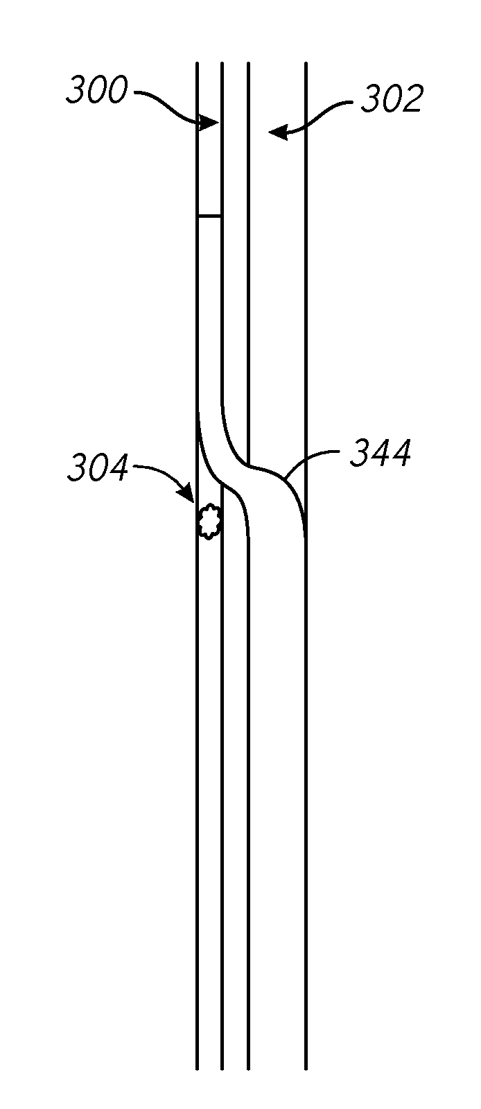 Devices and methods for treating lower extremity vasculature