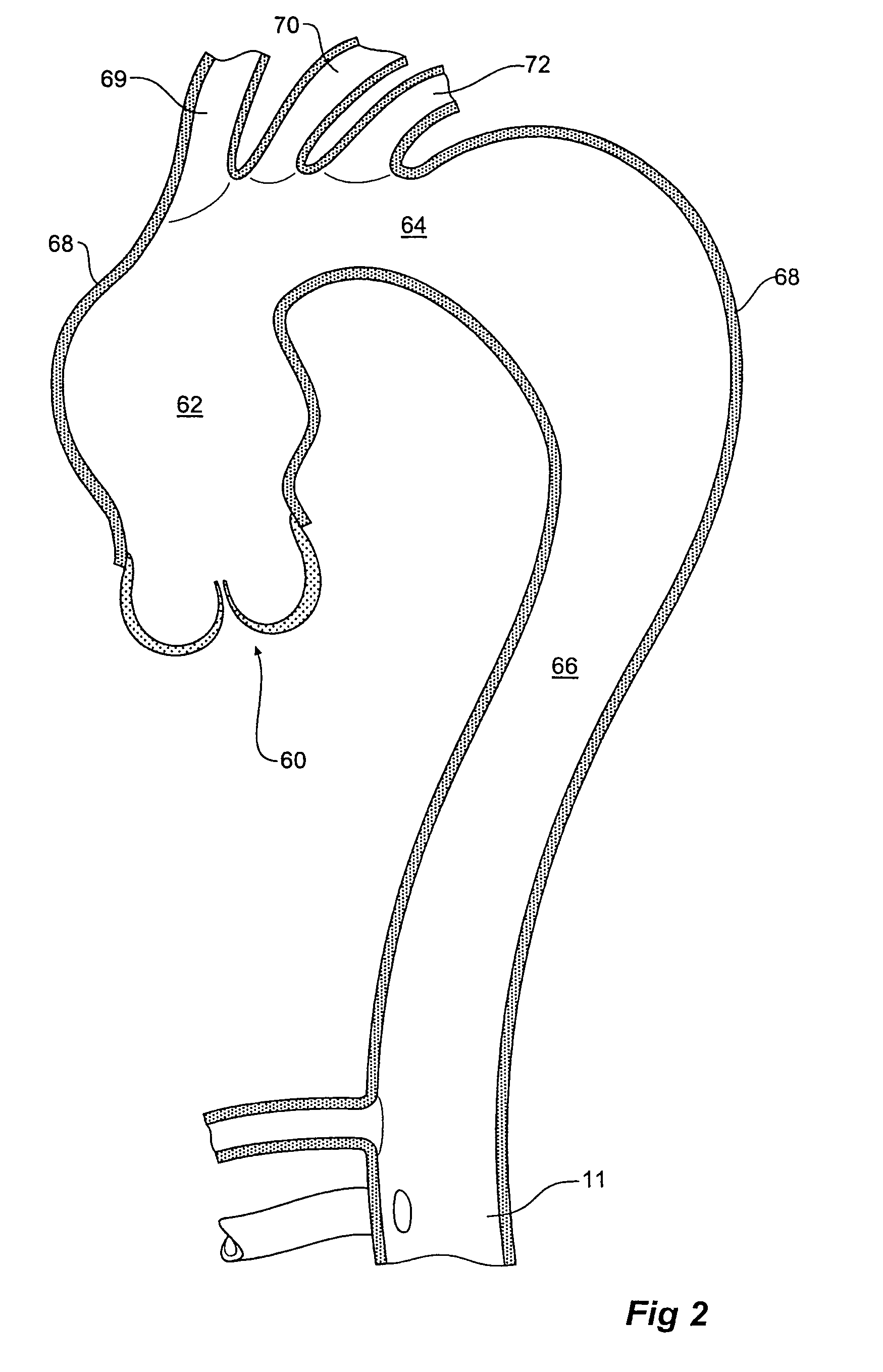 Device and method for treating thoracic aorta