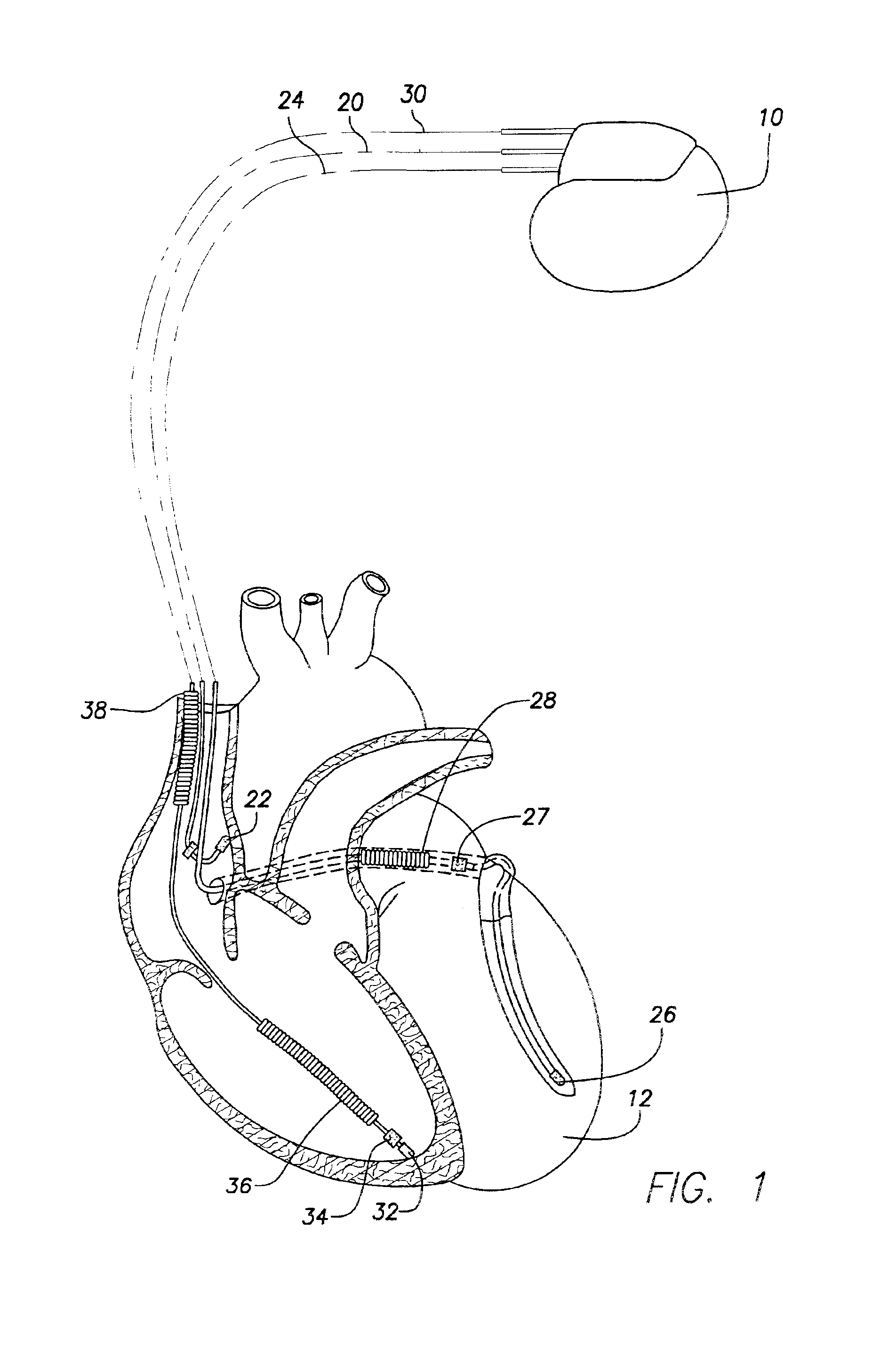 Pediatric rate varying implantable cardiac device