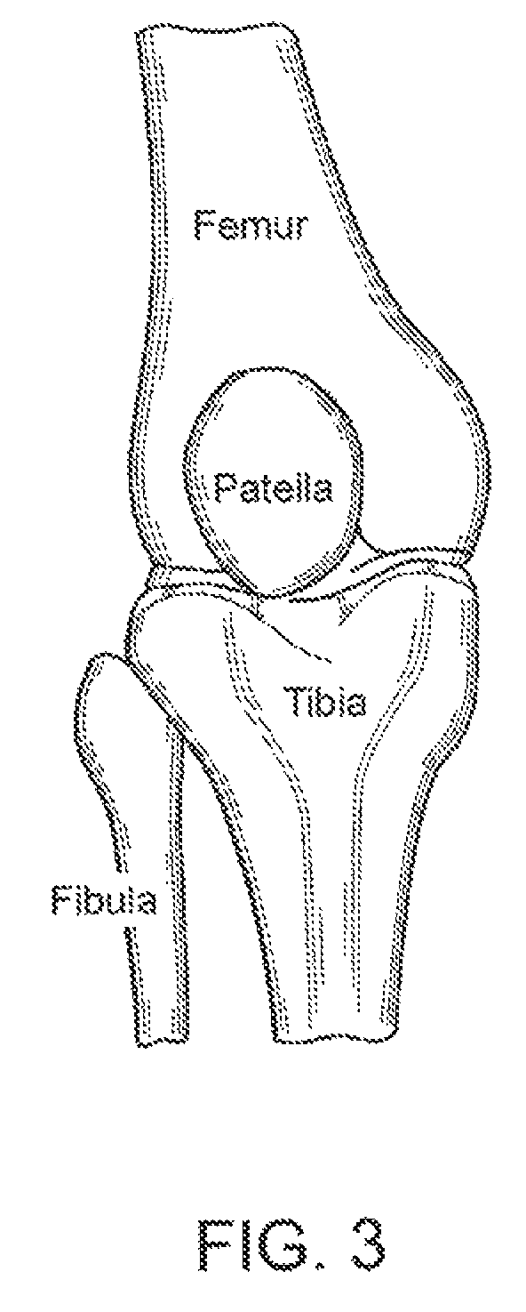 Method and apparatus for force redistribution in articular joints