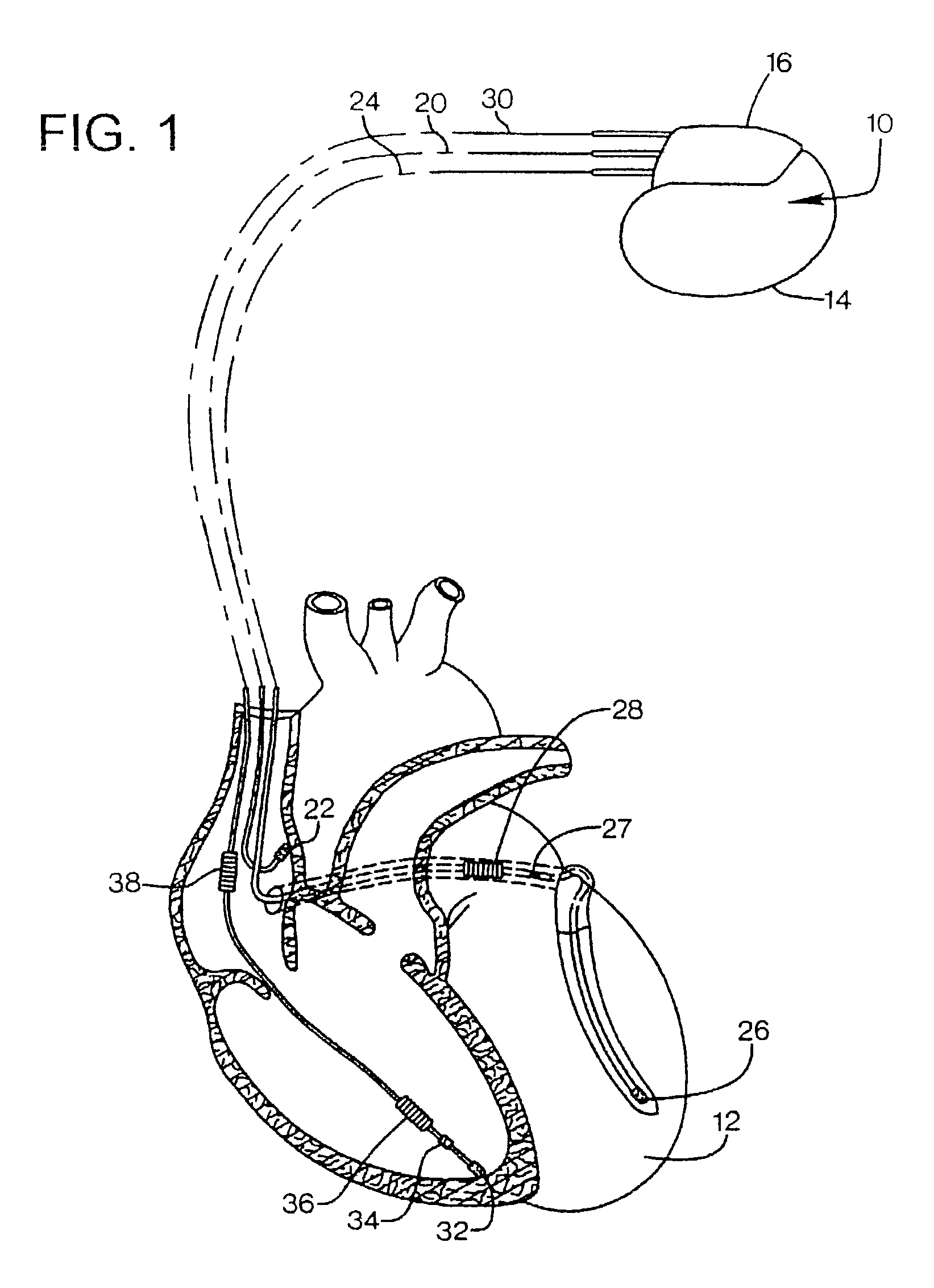 Stackable capacitor having opposed contacts for an implantable electronic medical device