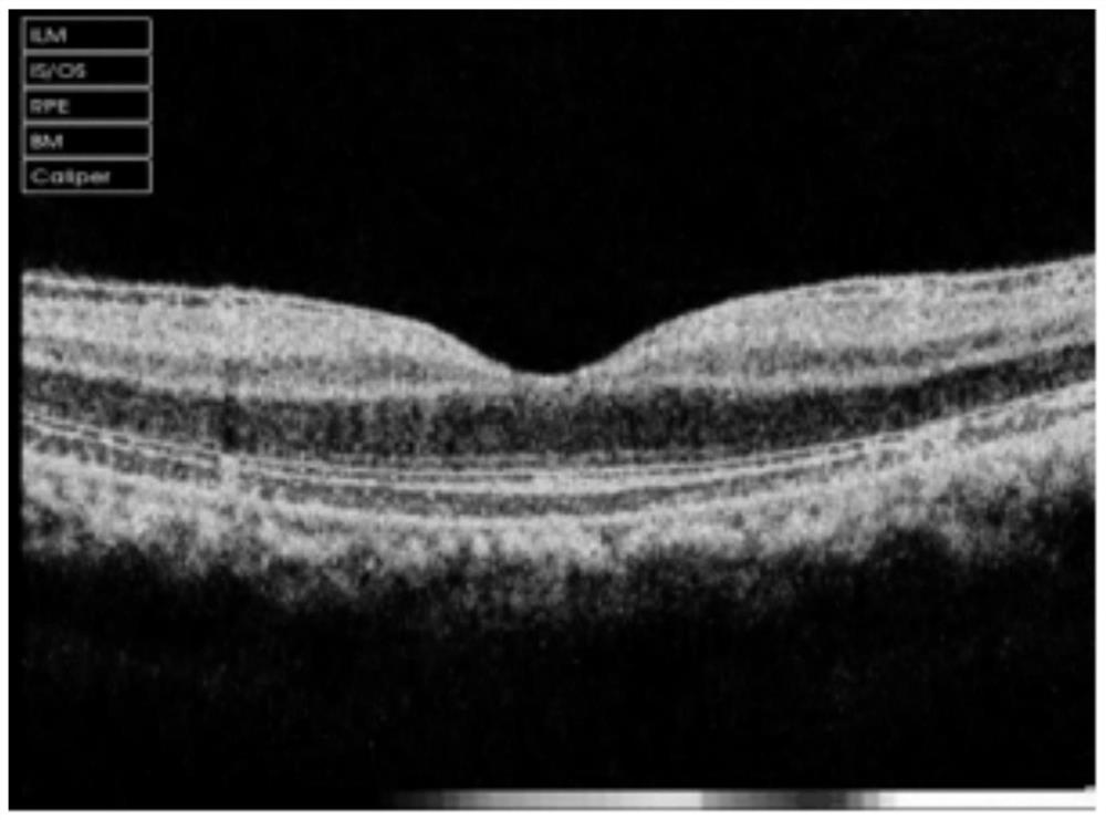 OCT image detection method and system based on retinal hierarchical data