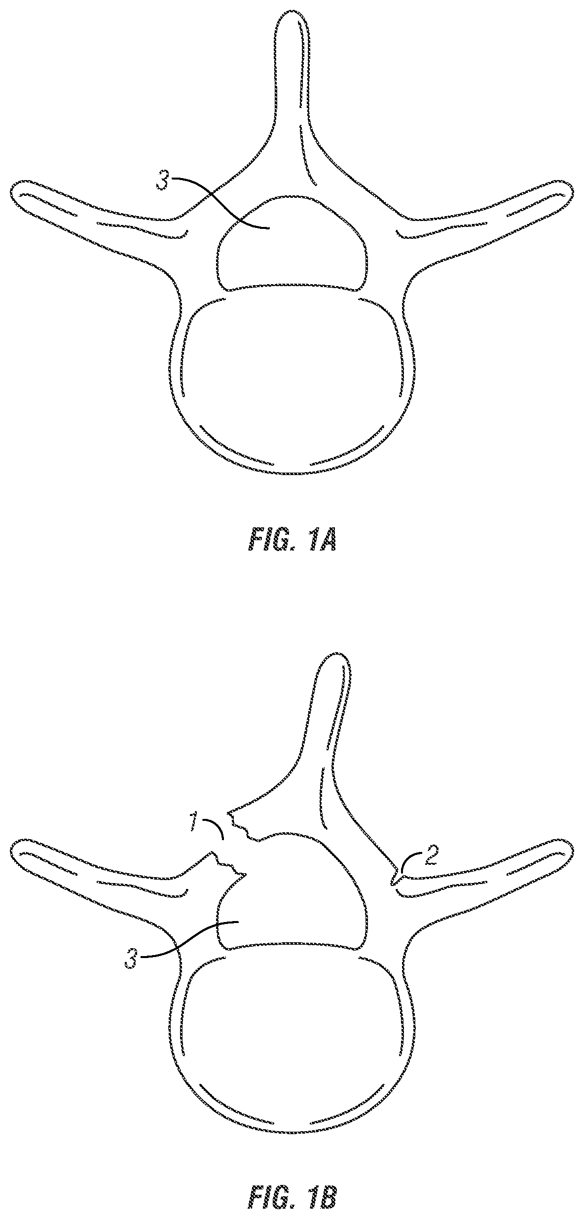 Laminoplasty plates, systems, and devices, and methods relating to the same