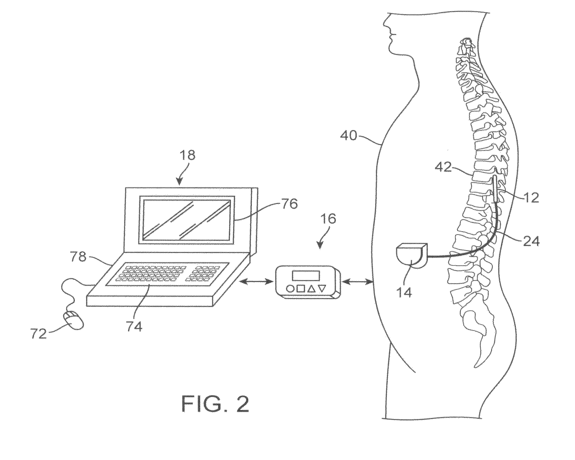 Display of region of activation in neurostimulation programming screen