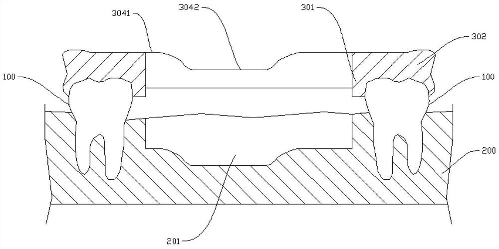 Implant guide plate assembly and implant slotting method