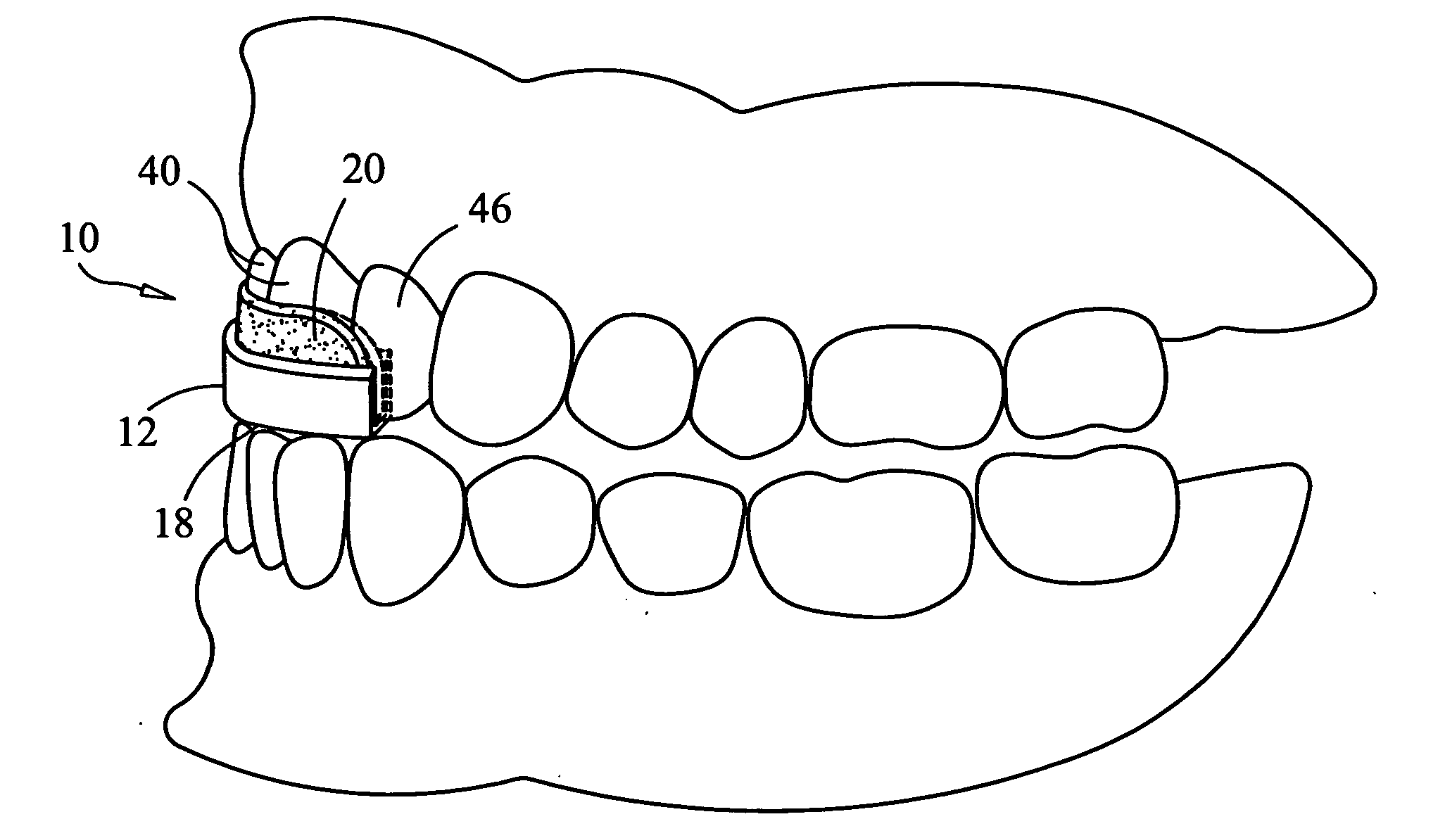 Dental appliance to prevent the negative effects of bruxism