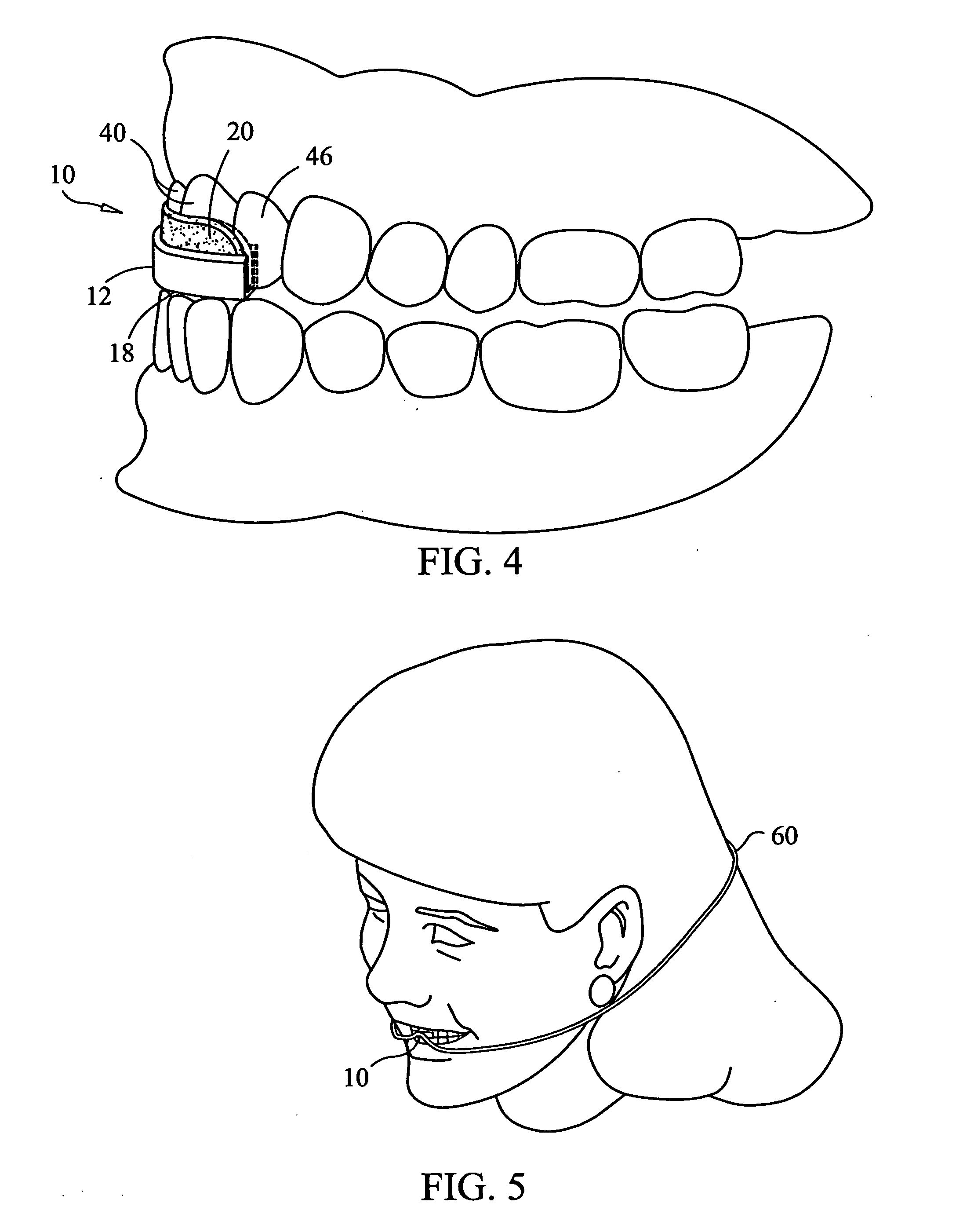 Dental appliance to prevent the negative effects of bruxism