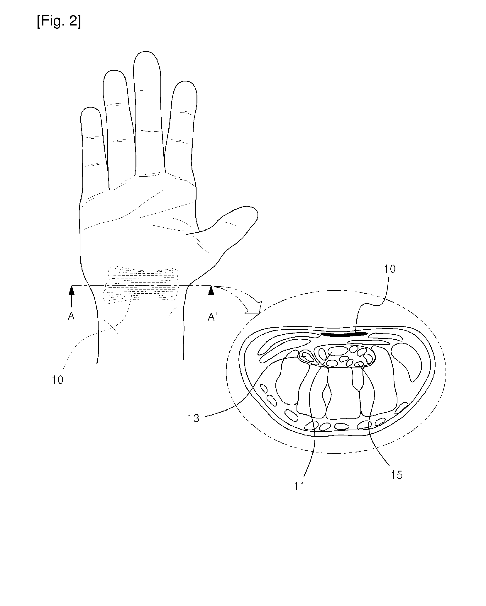 Surgical instrument, and medical kit for treating carpal tunnel syndrome