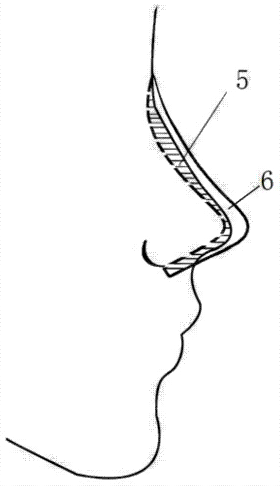 Method for laser engraving of nasal prosthesis