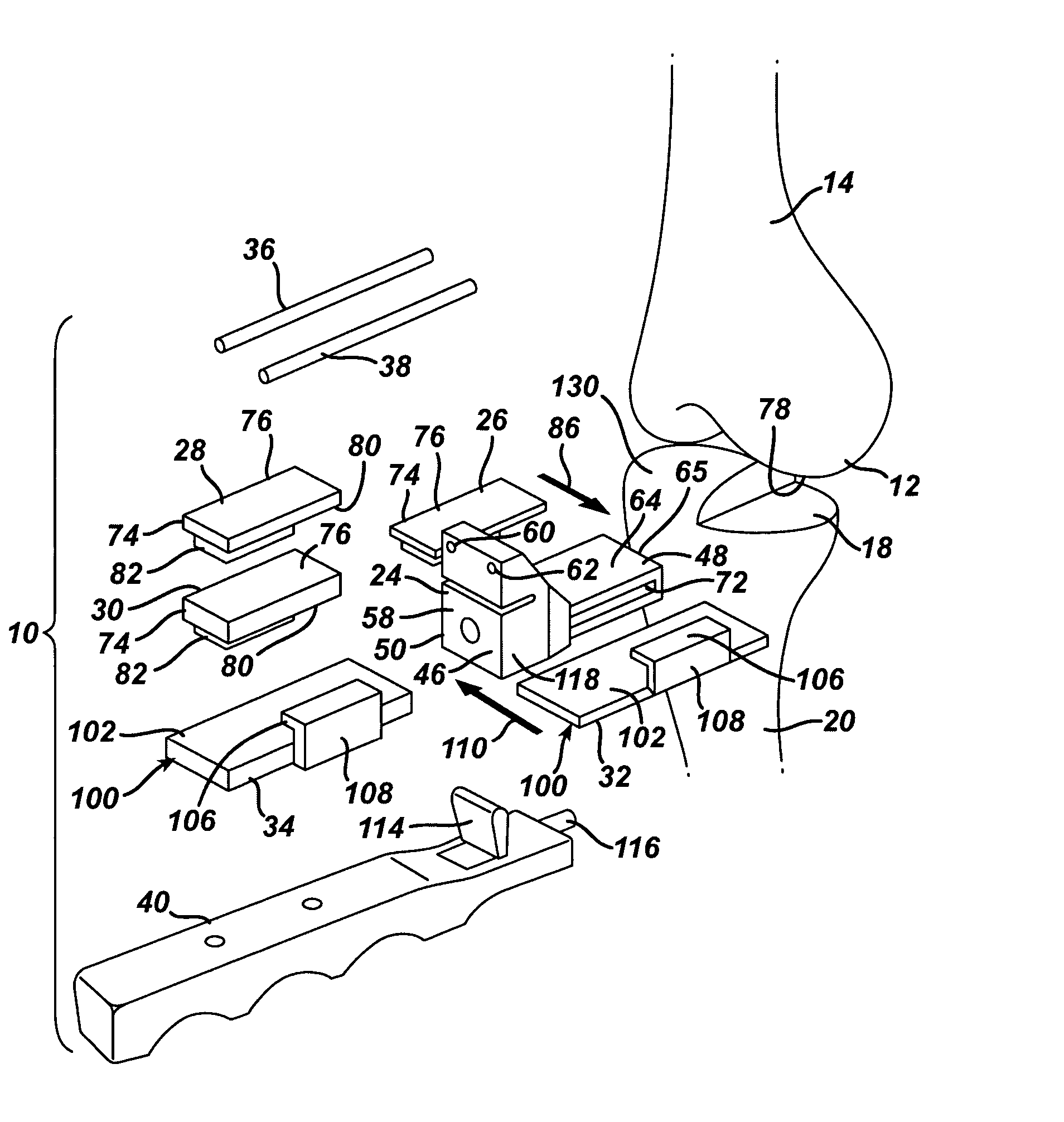 Kit, guide and method for locating distal femoral resection plane