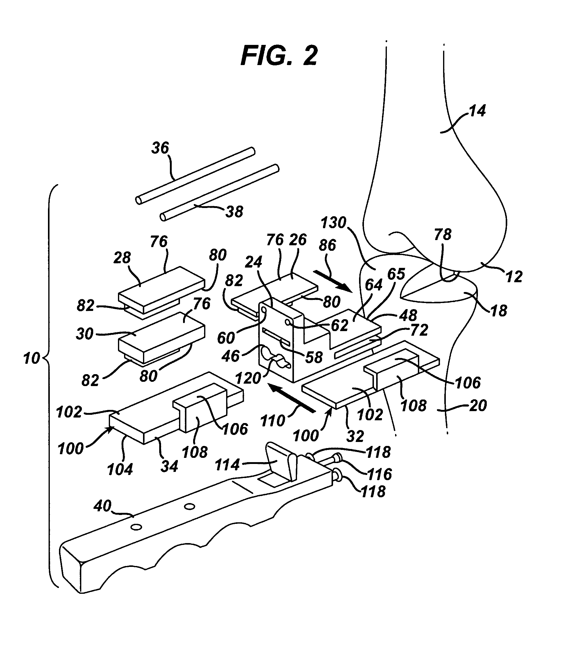 Kit, guide and method for locating distal femoral resection plane