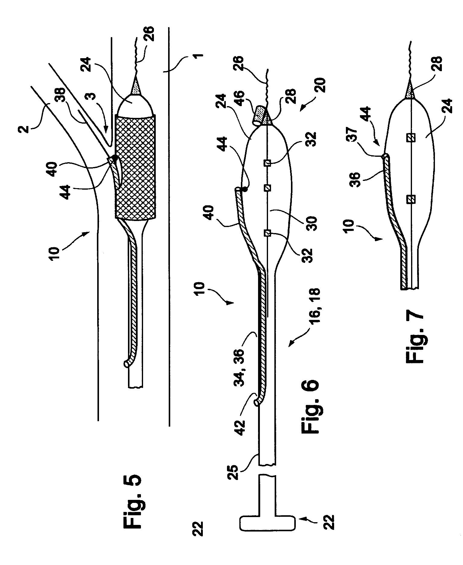 Vessel treatment devices