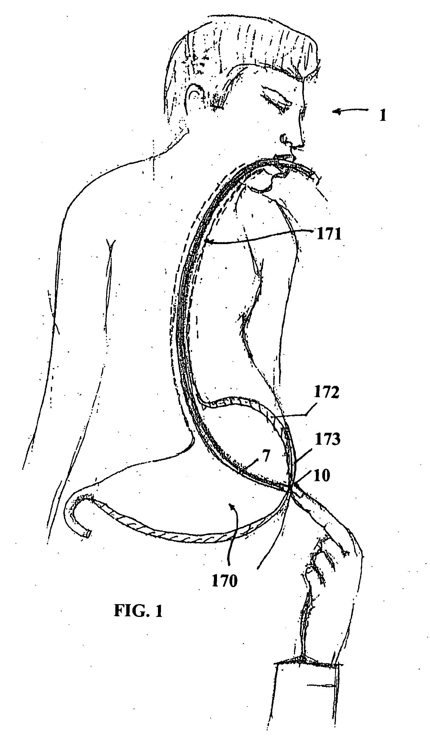 Feeding tube