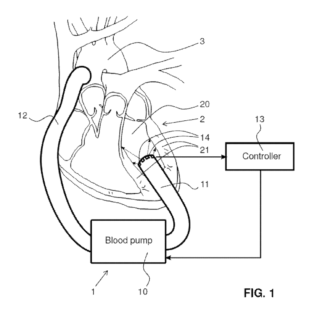 Biomedical apparatus for pumping blood of a human or an animal patient through a secondary intra- or extracorporeal blood circuit