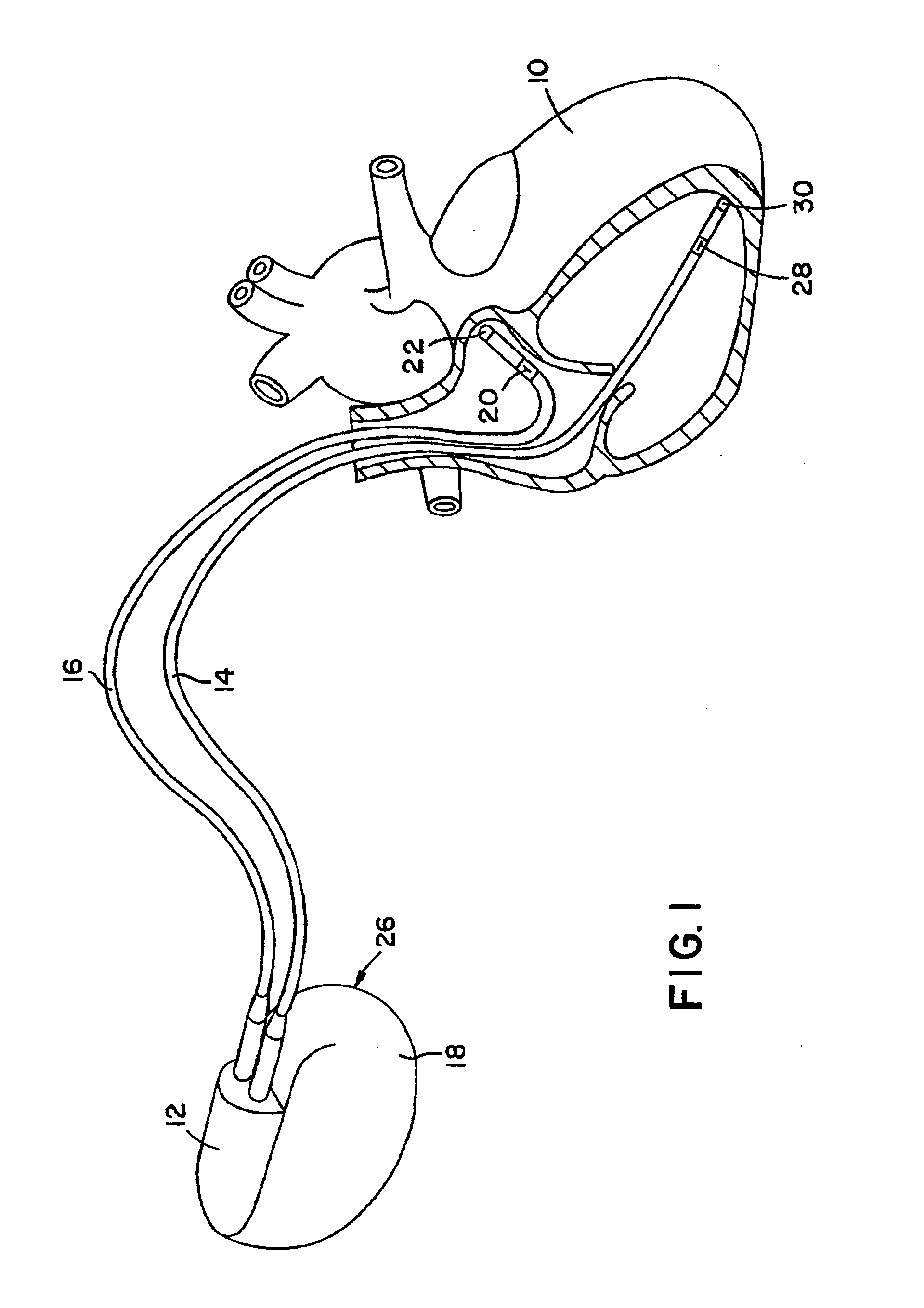 Dynamic adjustment of capture management "safety margin"