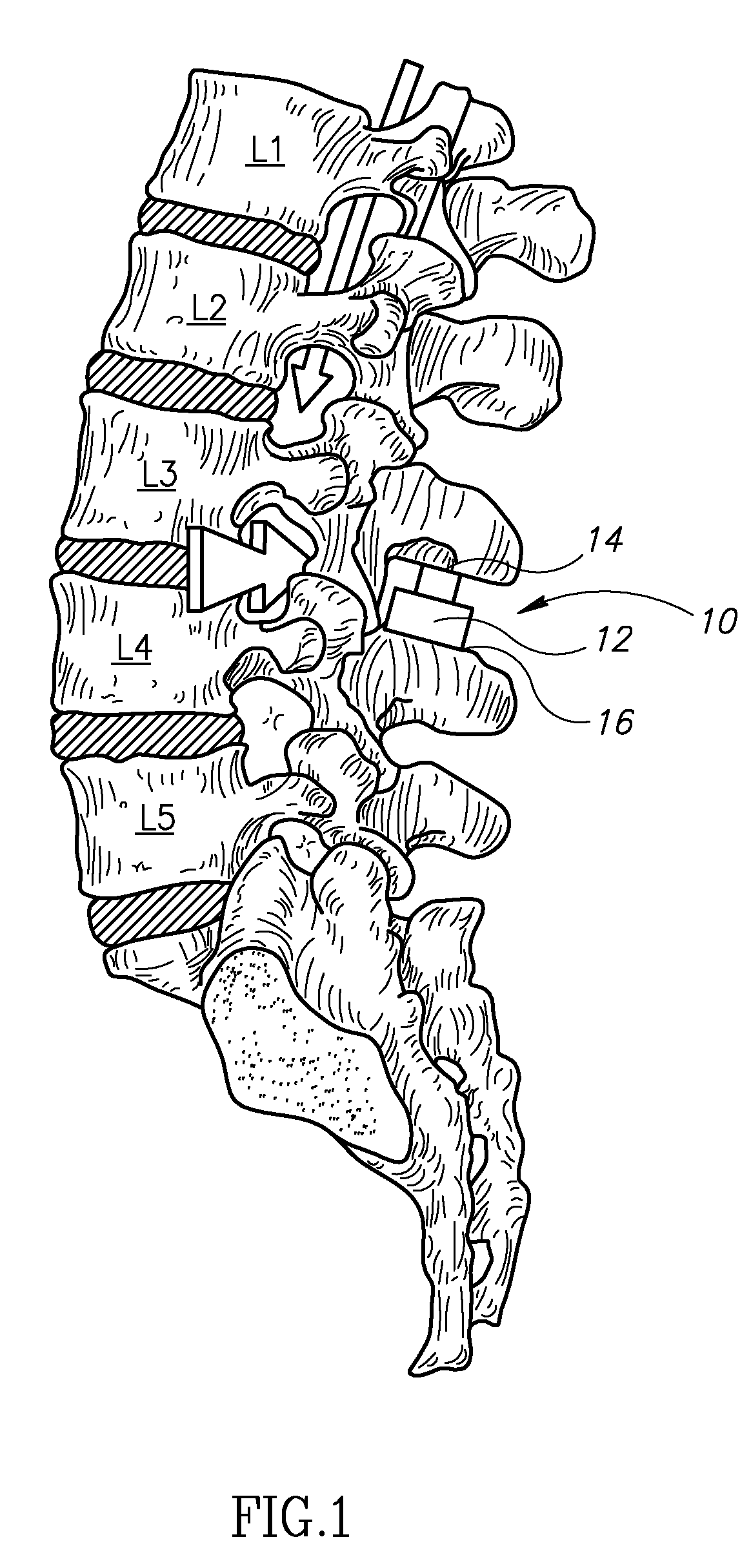 Spinal implant having a post-operative adjustable dimension