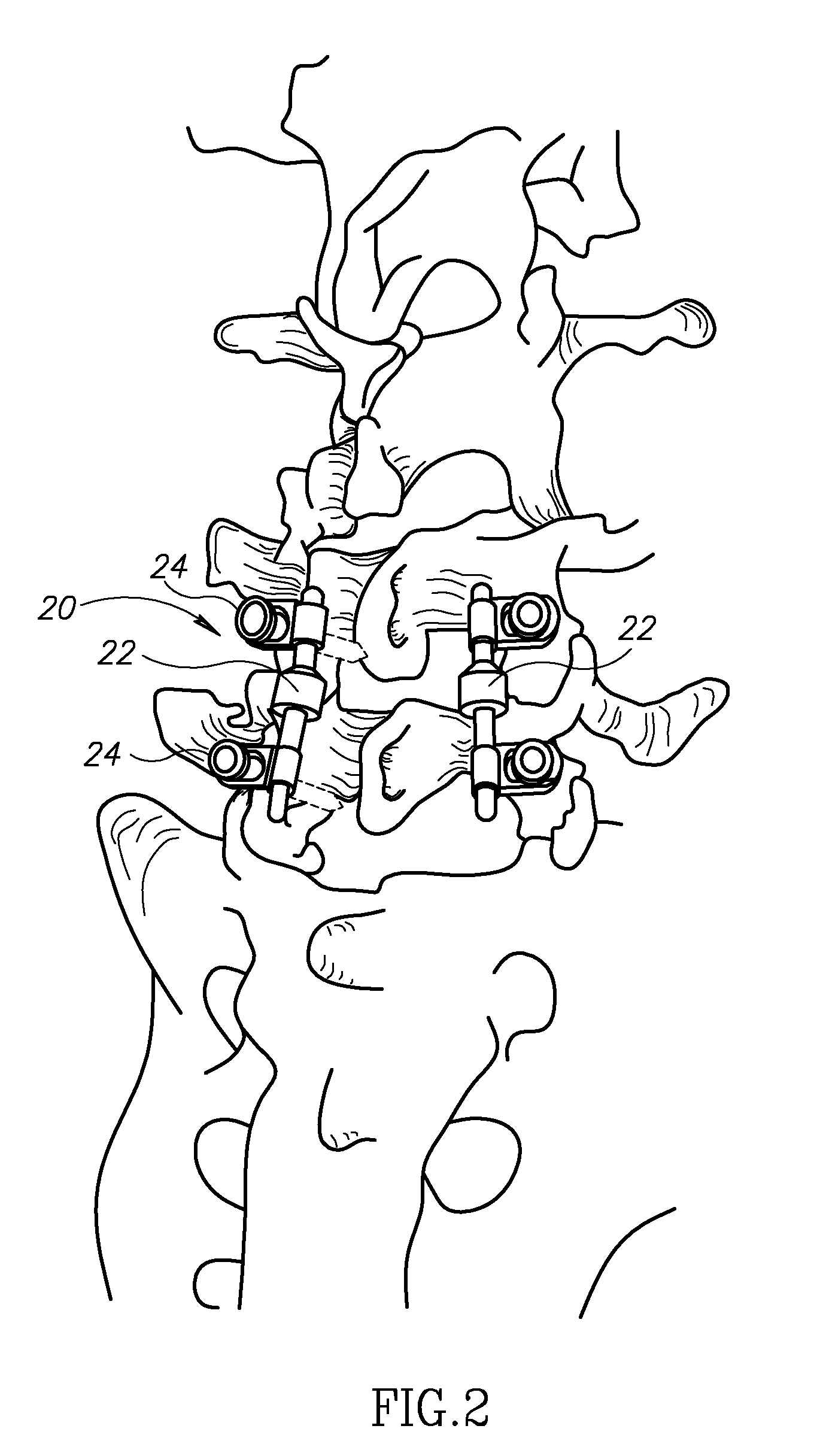 Spinal implant having a post-operative adjustable dimension