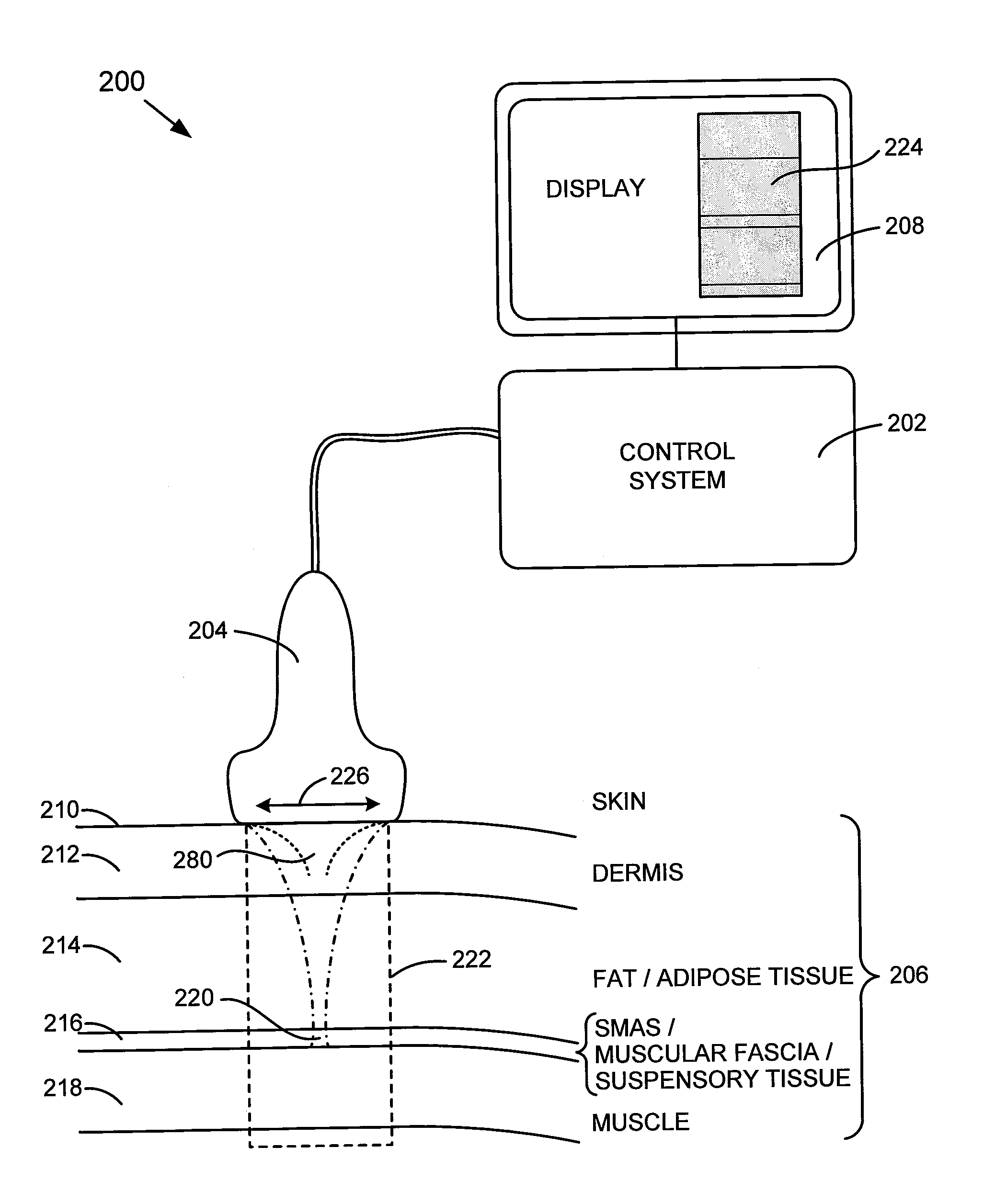 Method and system for noninvasive face lifts and deep tissue tightening