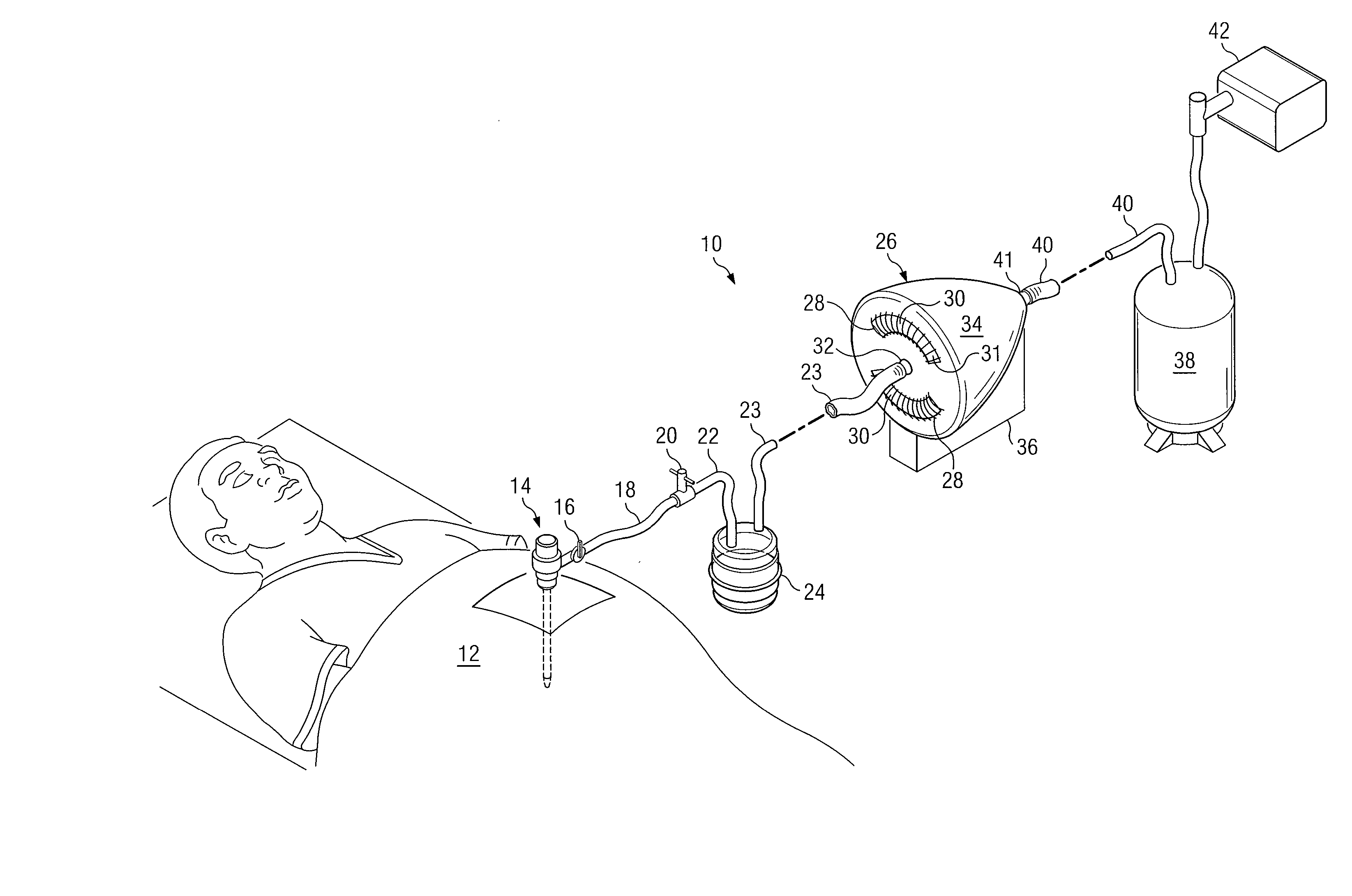 System and Method to Vent Gas From a Body Cavity