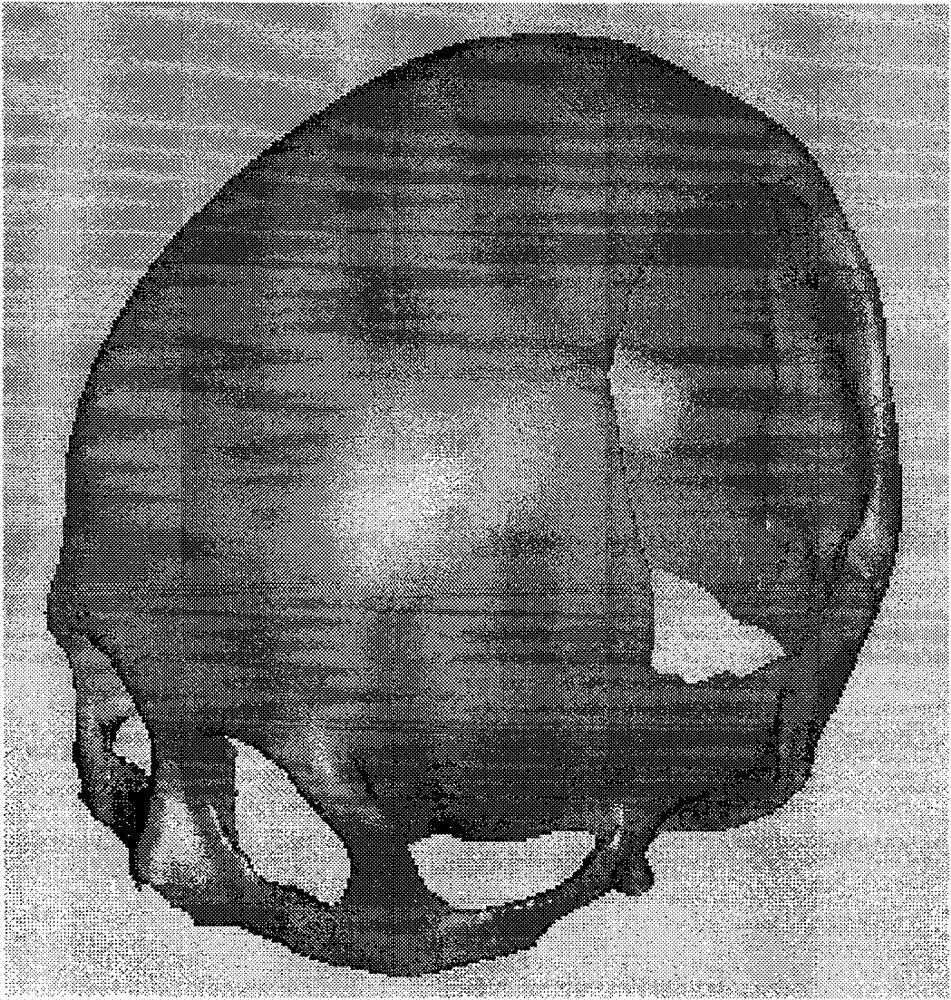 Digitalized preparation method of titanium mesh cranial prosthesis