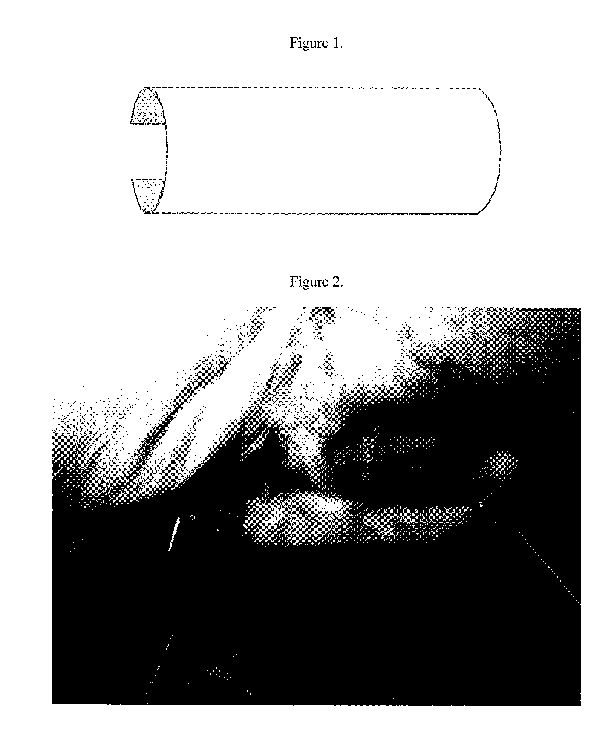 Method of tendon repair with amnion and chorion constructs