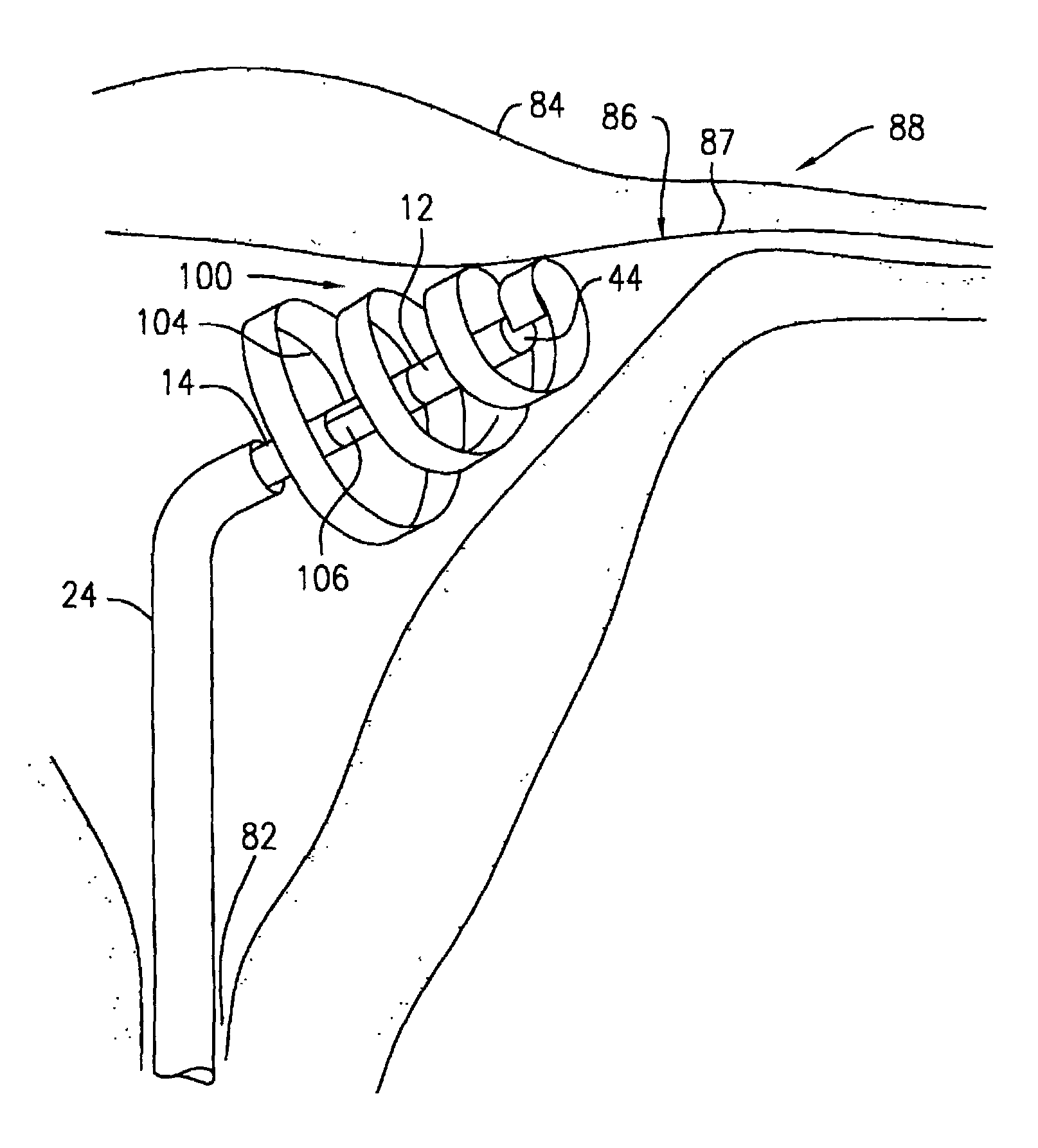 Apparatus and method for transcervical sterilization by application of ultrasound