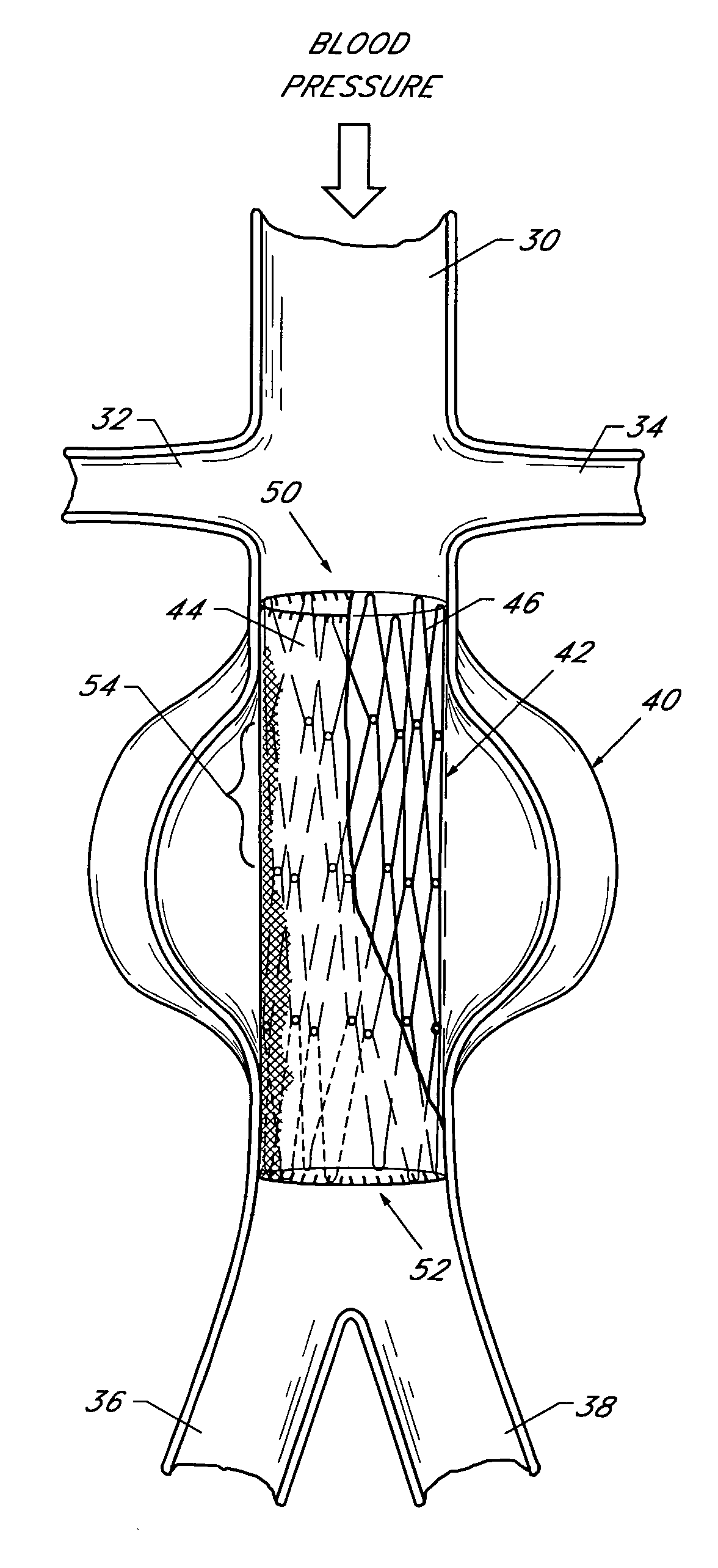 Endolumenal vascular prosthesis with neointima inhibiting polymeric sleeve