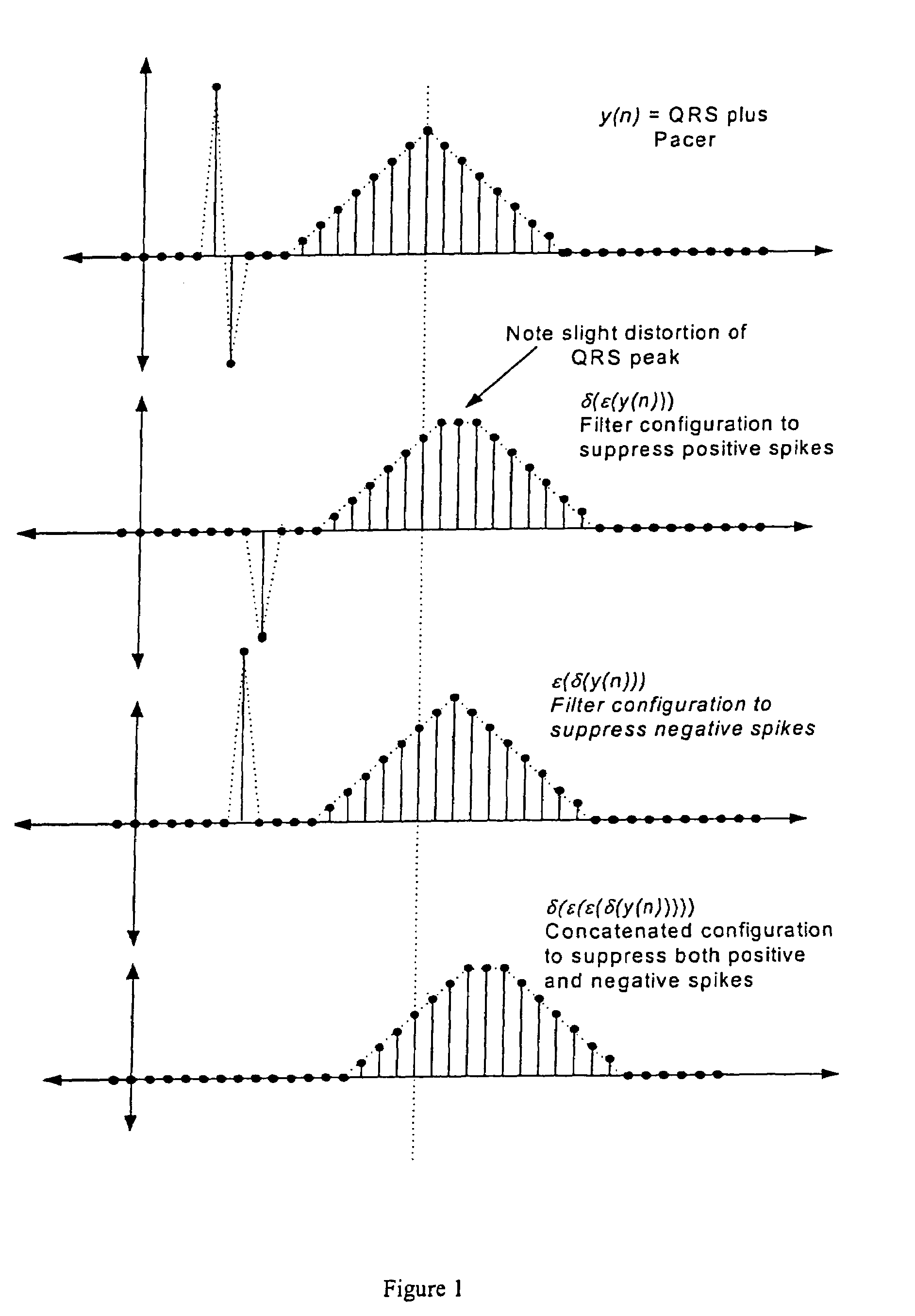 Nonlinear method and apparatus for electrocardiogram pacemaker signal filtering