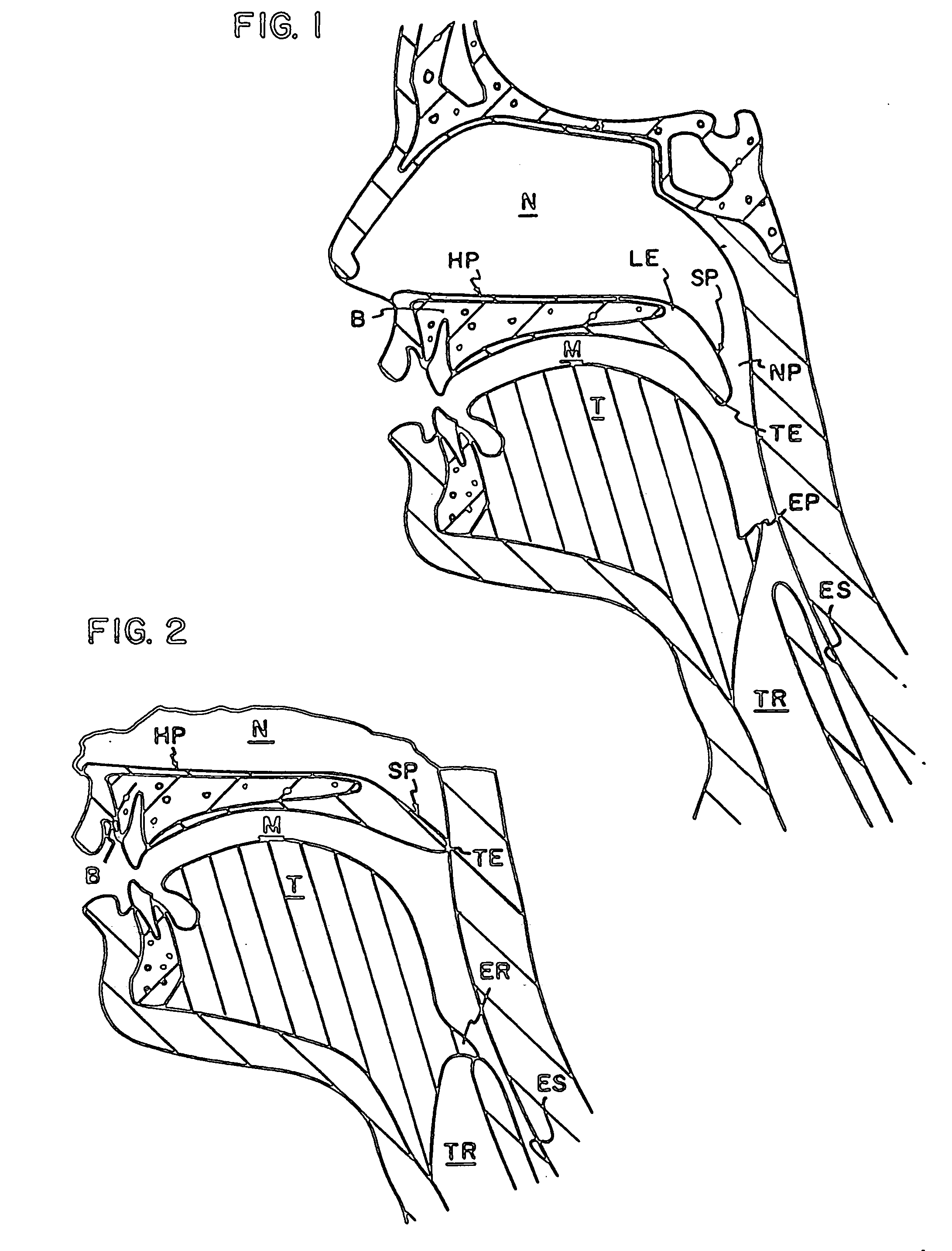 Injectable snoring implant