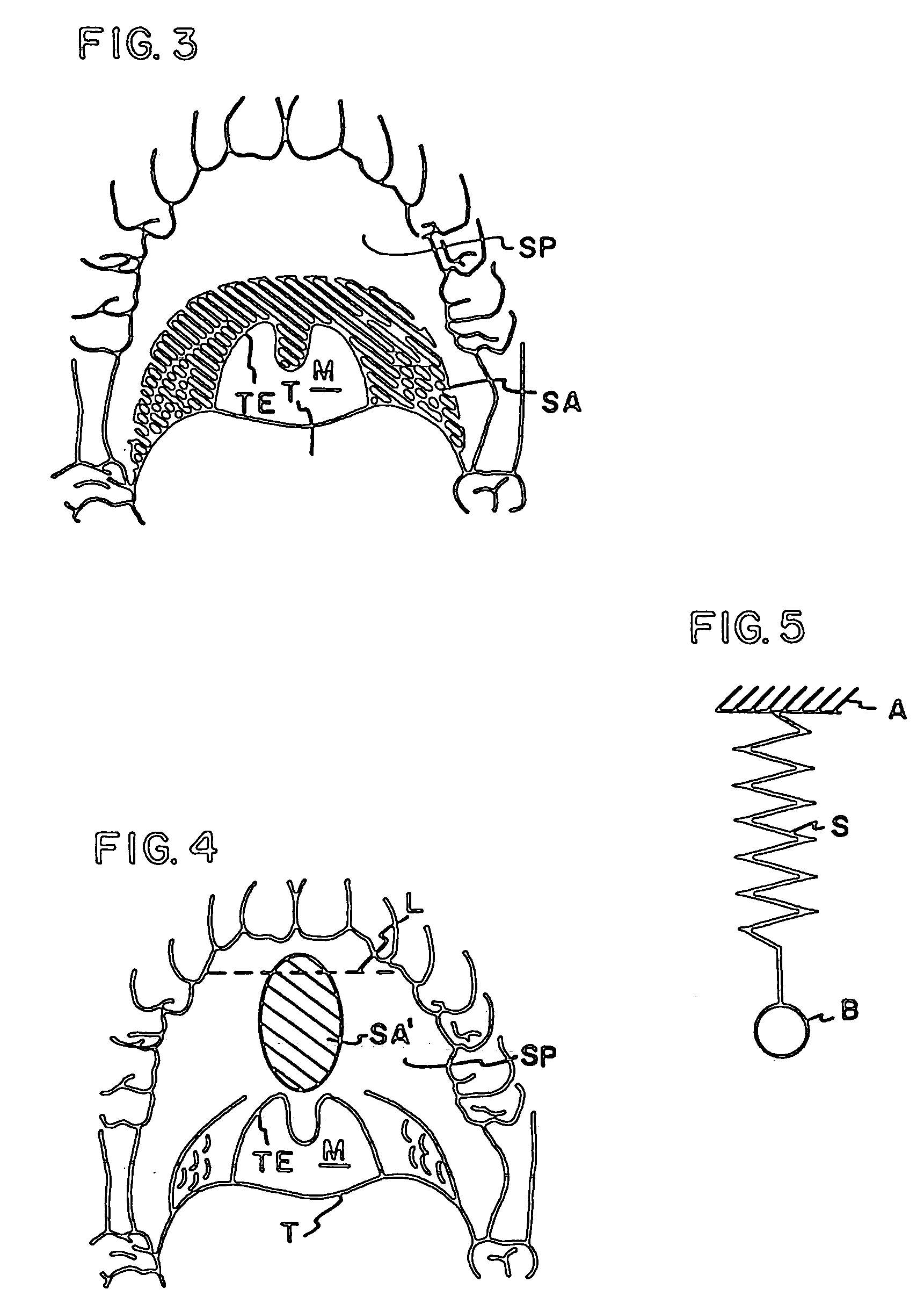 Injectable snoring implant