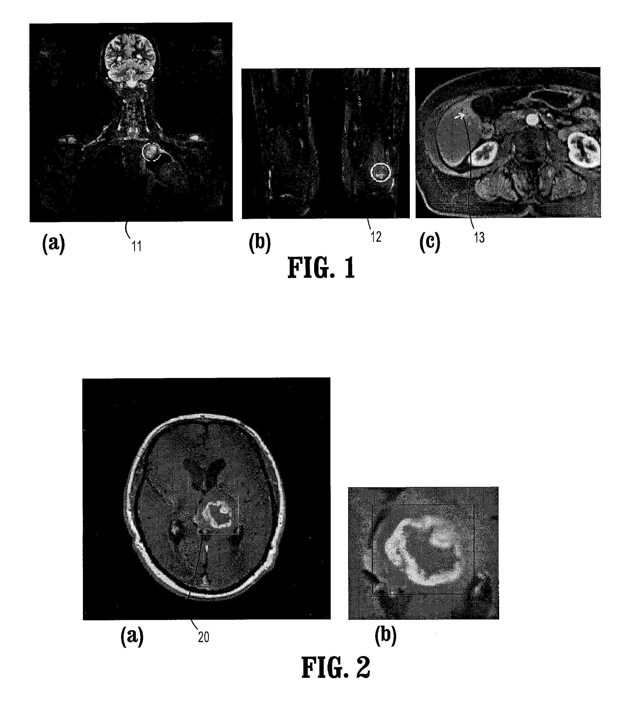 System and Method for Lesion Segmentation in Whole Body Magnetic Resonance Images