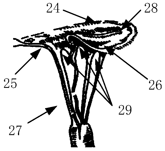 A kind of atrioventricular valve support and its delivery system for puncture implantation