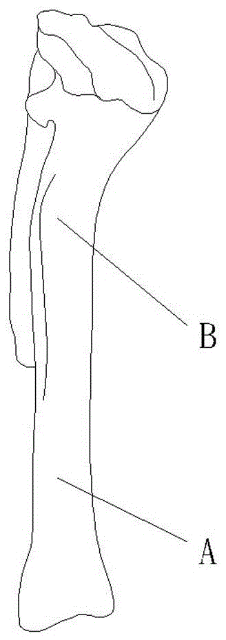 combined osteotomy guide